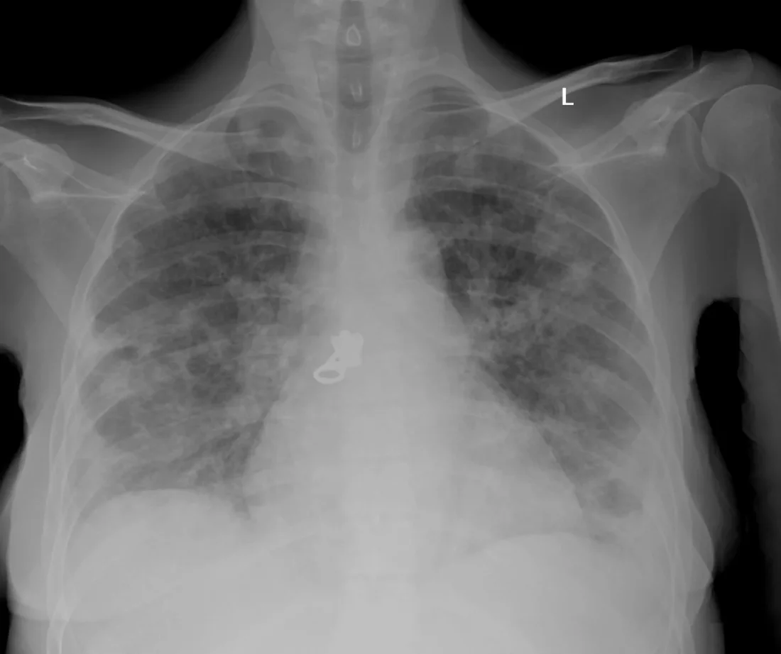 Röntgen-Thorax im Stehen von vorn: in beiden Lungen mehrere fleckige und rundliche, teils zusammenfließende Verschattungen, betont in Mittel- und Unterfeldern; Herzschatten normal groß; kleines Metallteil über der Bildmitte