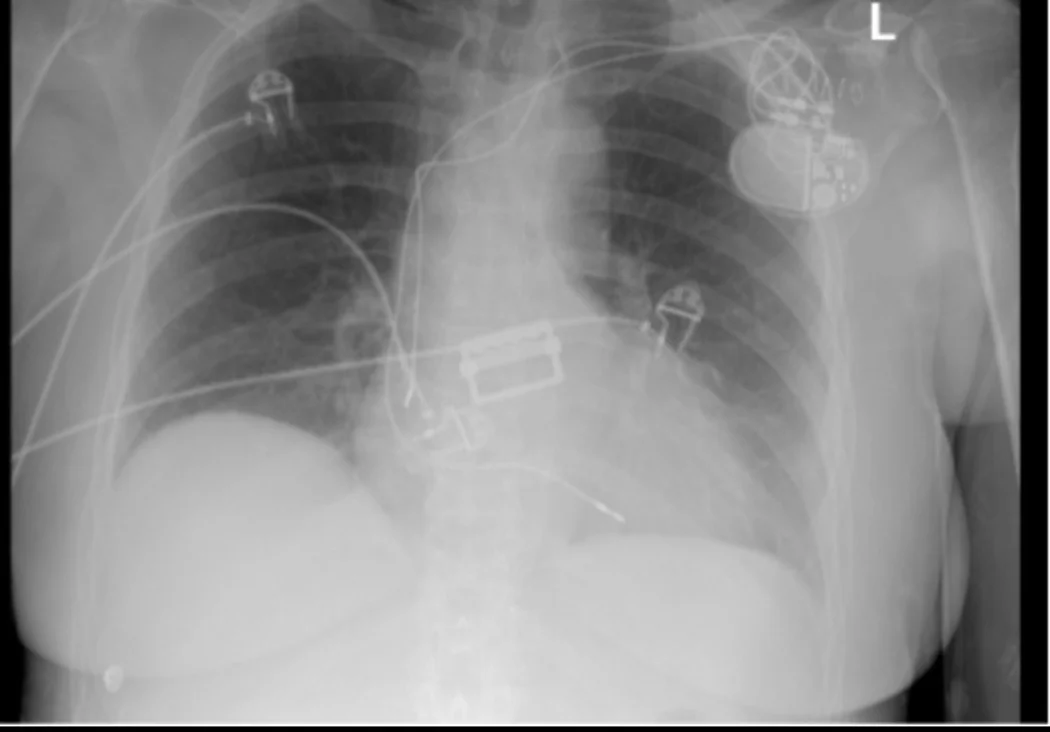 Röntgen-Thorax im Halbsitzen von vorn: Aggregat unter dem linken Schlüsselbein, zwei Sondenkabel ziehen in das Herz, eines endet im Bereich des rechten Vorhofs, eines zur Herzspitze; dazu EKG-Elektroden und Kabel auf der Haut