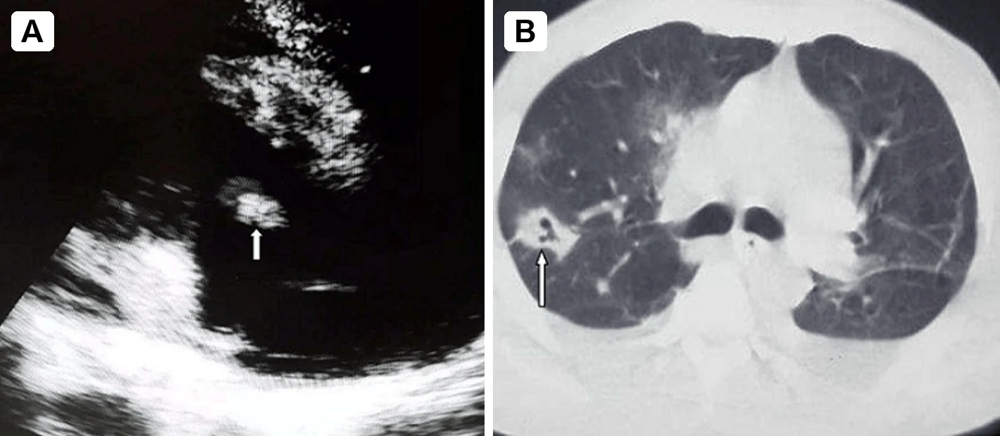 A: Echobild im apikalen Vierkammerblick mit einer rundlichen, echodichten Masse an der Trikuspidalklappe, markiert mit einem weißen Pfeil. B: Axiale CT des Thorax im Lungenfenster mit einem rundlichen Herd in der rechten Lunge, der zentral eine Luftaufhellung zeigt, markiert mit einem weißen Pfeil.