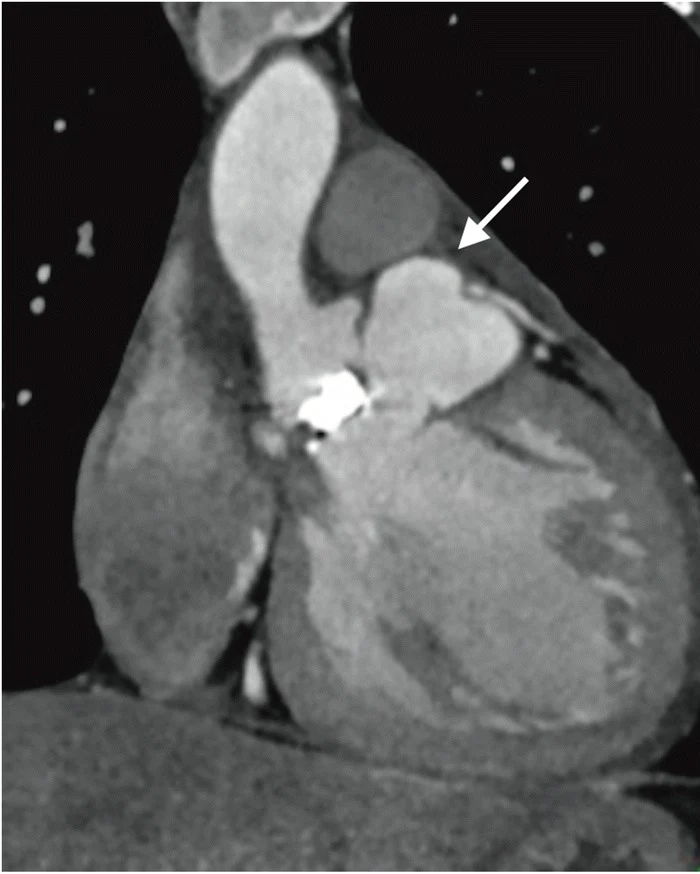 Kontrastmittel-CT des Herzens in schräger Längsschnittebene: aufsteigende Aorta, helle metalldichte Klappenprothese und daneben eine mit Kontrastmittel gefüllte, ausgesackte Höhle am Ausflusstrakt des linken Ventrikels, markiert mit einem Pfeil.