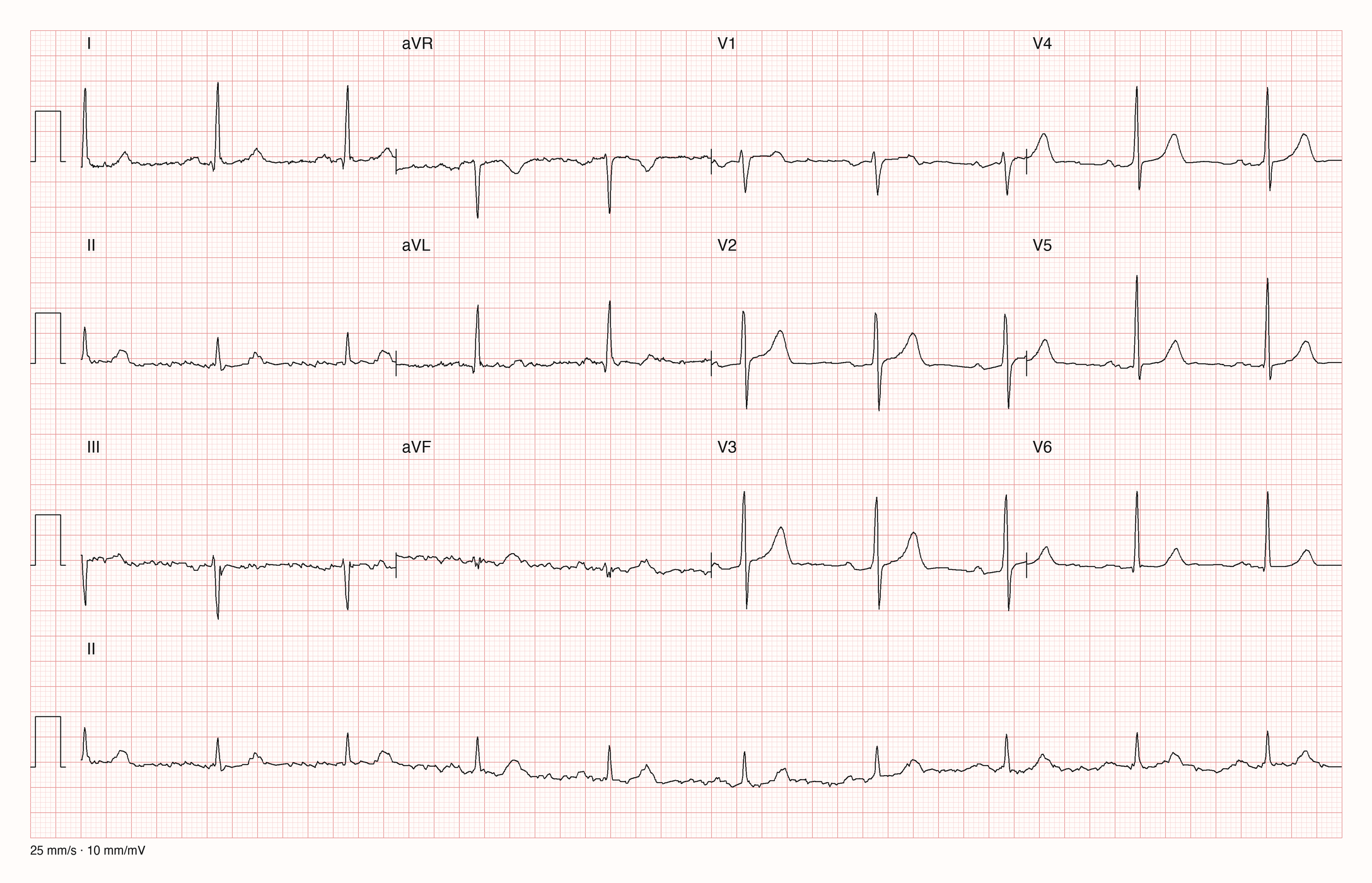 12-Kanal-EKG in Ruhe, Sinusrhythmus, Papiergeschwindigkeit 25 mm/s, 10 mm/mV