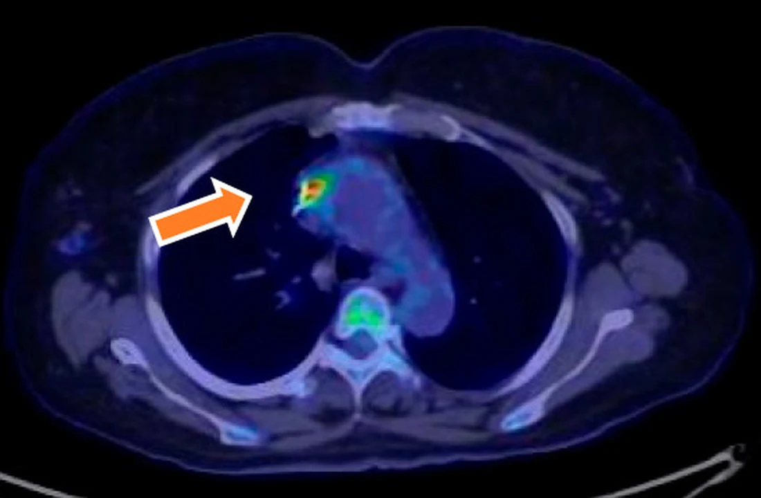 Axiale fusionierte PET/CT-Schicht des Thorax in Blautönen; ein oranger Pfeil zeigt auf einen kleinen, kräftig gelb-rot leuchtenden Herd im vorderen Mediastinum im Bereich der Aortenklappenprothese.
