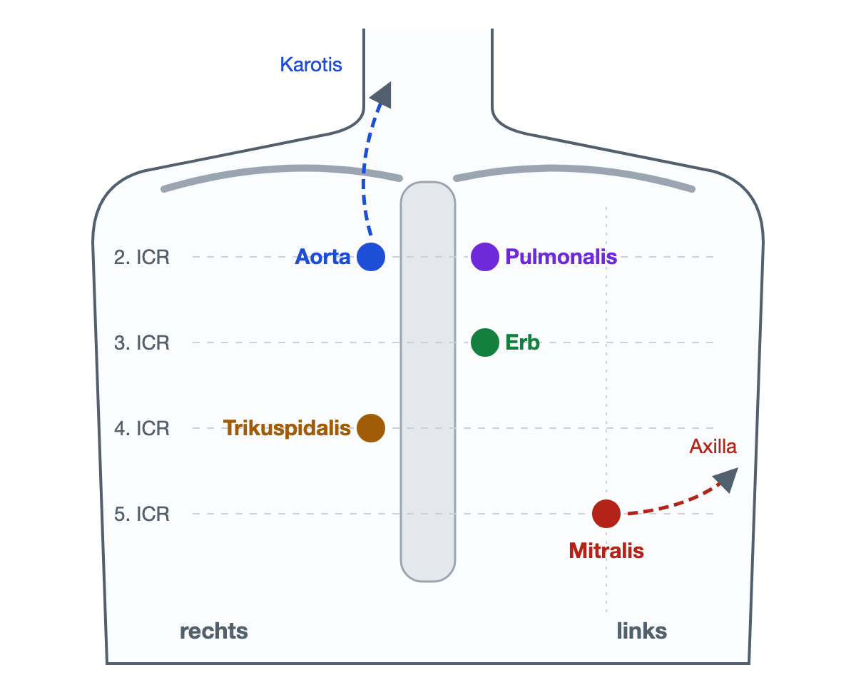 Einfache Rumpfkontur mit Brustbein und Linien für den 2. bis 5. Interkostalraum; farbige Punkte für Aorten-, Pulmonal-, Erb-, Trikuspidal- und Mitralareal; gestrichelte Pfeile vom Aortenareal zur Karotis und vom Mitralareal zur Axilla