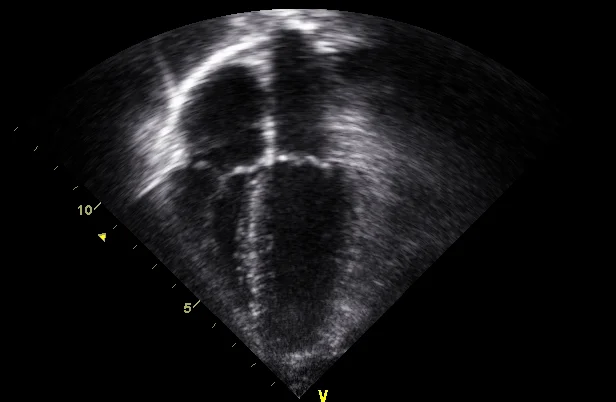Ultraschallschnittbild in Graustufen: oben zwei dunkle Vorhöfe, unten zwei dunkle Kammern, dazwischen eine helle quere Linie; die Herzspitze zeigt nach unten