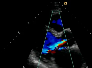 Ultraschalllängsschnitt mit einem bunten, mosaikartigen Farbsignal aus Rot, Gelb und Blau unterhalb der Aortenklappe im Ausflusstrakt des linken Ventrikels