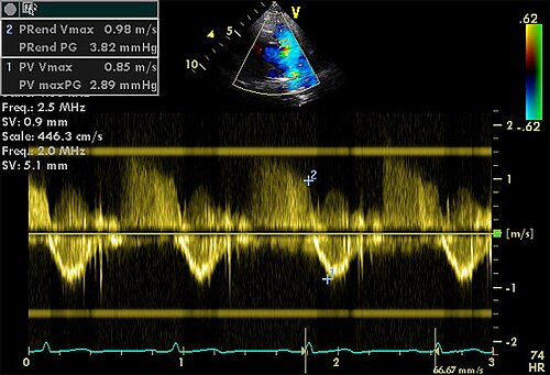 Gepulster Doppler: unterhalb der Nulllinie löffelförmige Flusskurven, oberhalb ein flaches Flusssignal; links oben ein Messfeld mit Geschwindigkeiten in m/s und Gradienten in mmHg
