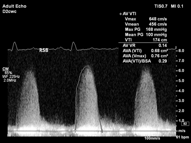 CW-Doppler-Spektrum mit drei dichten, spitzen Flusskurven bis etwa 6,5 m/s; eine gepunktete Linie umfährt die mittlere Kurve; rechts oben ein Messfeld mit Vmax, Vmean, Max PG und Mean PG