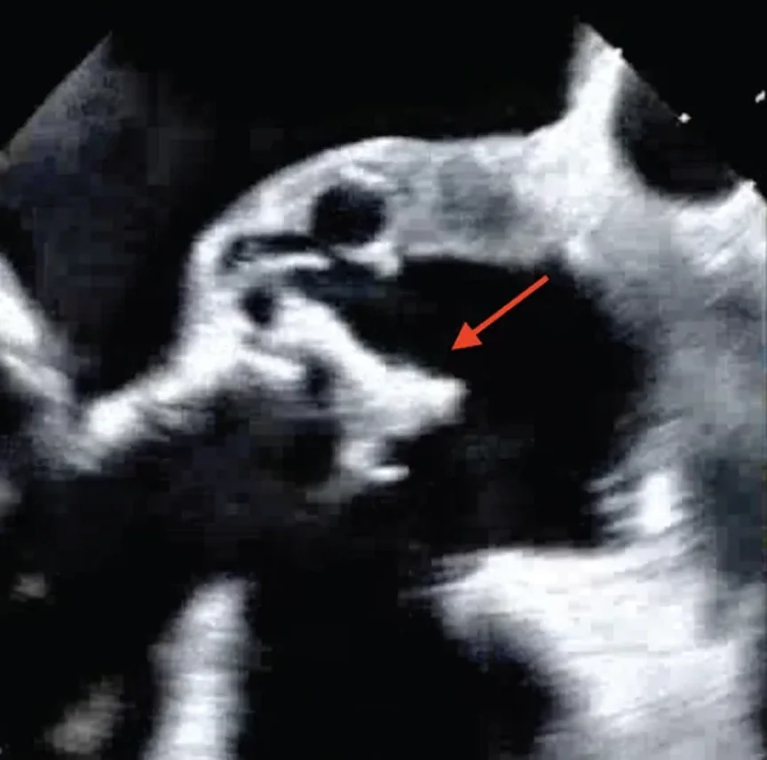 Echtes transösophageales Echobild in der langen Achse der Aortenklappe; an der biologischen Prothese hängt eine große, unregelmäßige, helle Masse, auf die ein roter Pfeil zeigt