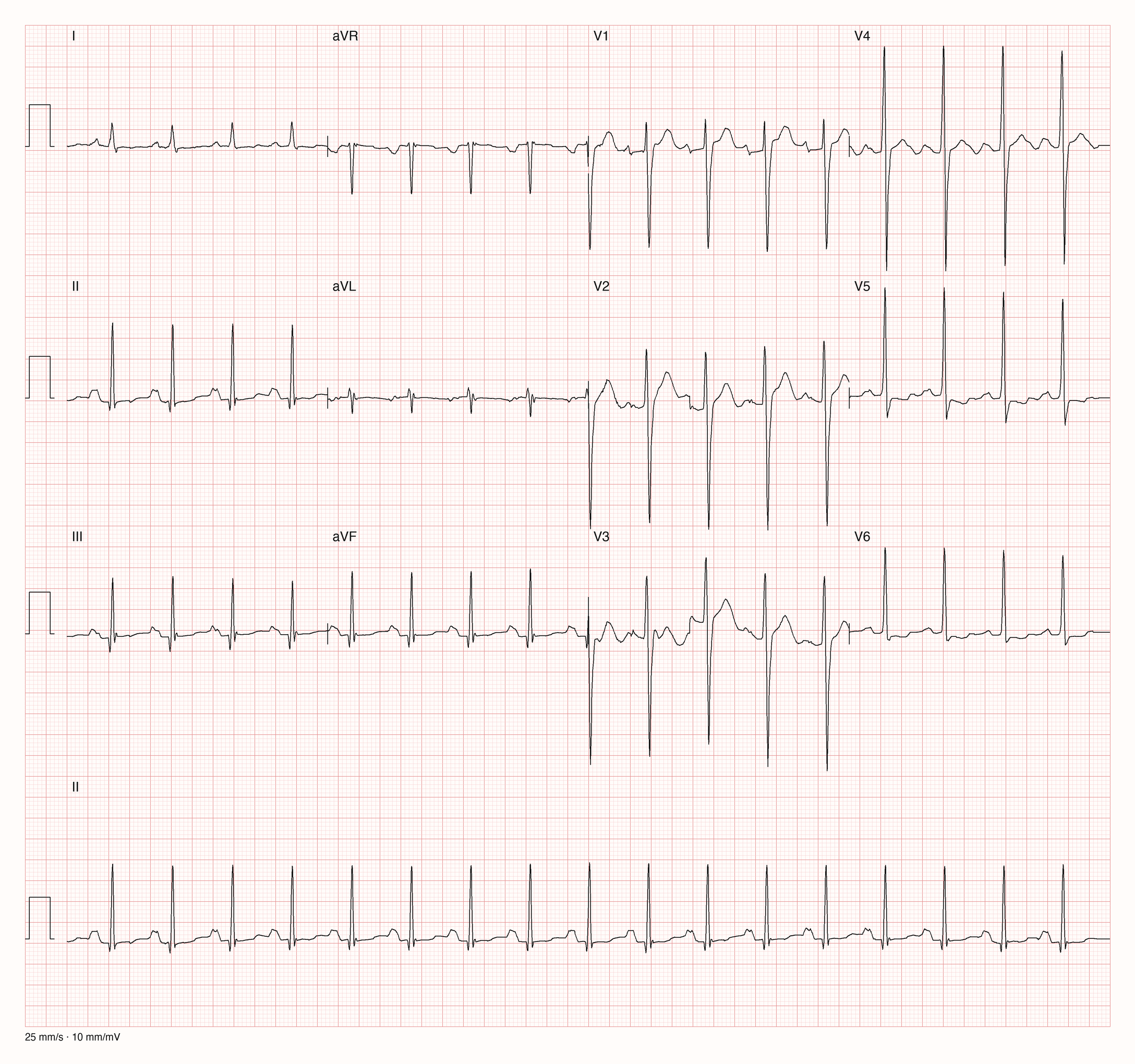 12-Kanal-EKG mit regelmäßigem schnellem Rhythmus, sehr tiefen S-Zacken in V1 bis V3, sehr hohen R-Zacken in V4 bis V6, gehobenen ST-Strecken in V1 bis V3 und flachen bis negativen T-Wellen in V5 und V6