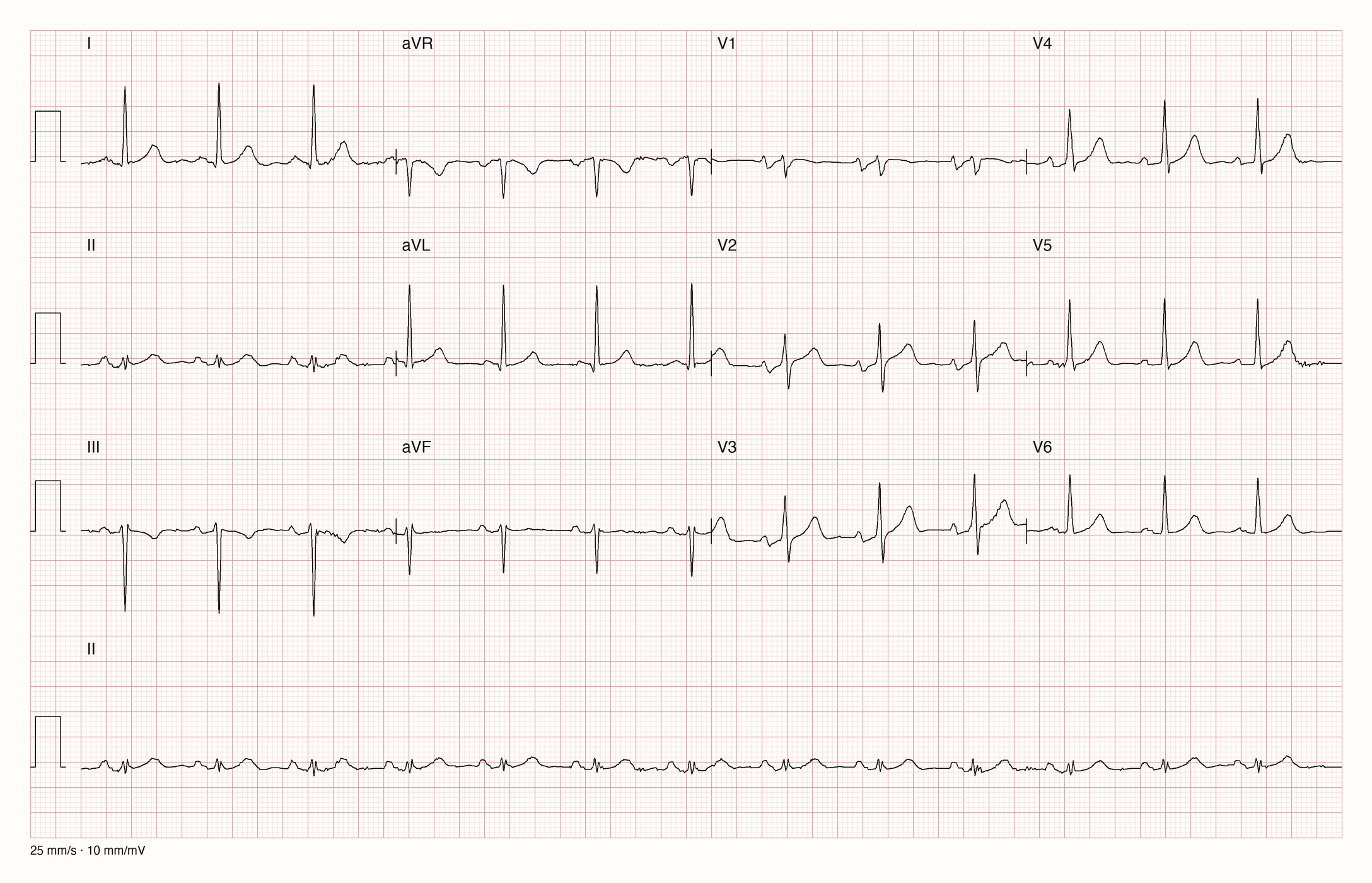 12-Kanal-EKG mit regelmäßigem Rhythmus, positivem QRS in I und aVL, negativem QRS in III und aVF, nahezu isoelektrischem QRS in II und zweiphasigen P-Wellen in V1 mit breitem negativem Anteil