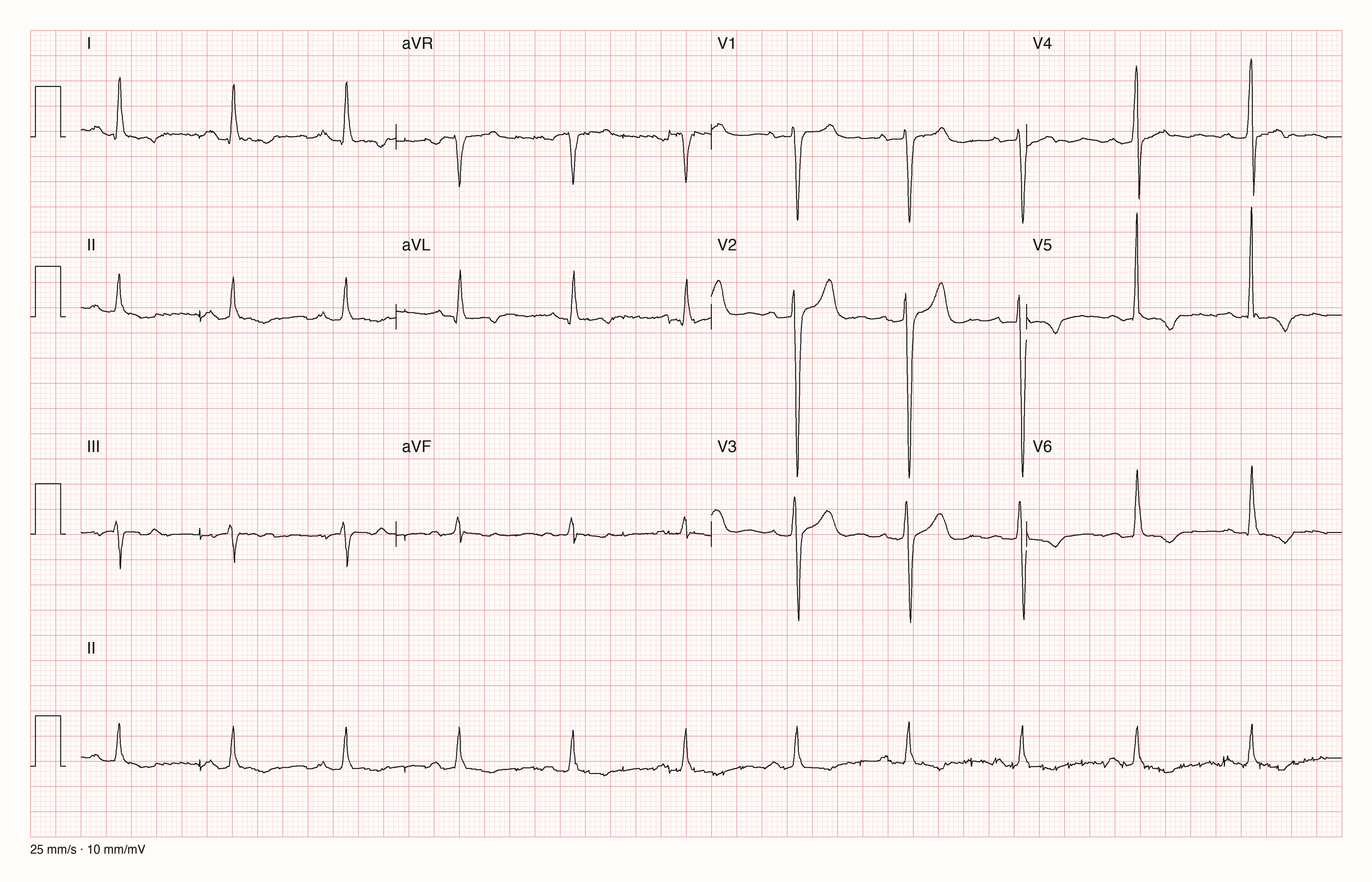 12-Kanal-EKG mit tiefen S-Zacken in V1 bis V3, hohen R-Zacken in V4 und V5, negativen T-Wellen in V5, V6, I und aVL sowie gehobenen ST-Strecken mit hohen T-Wellen in V2 und V3