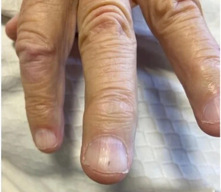 Echtes Foto von drei Fingern auf einem hellen Tuch; im distalen Drittel des Mittelfingernagels liegt ein kurzer, dunkelroter bis schwarzer Längsstrich