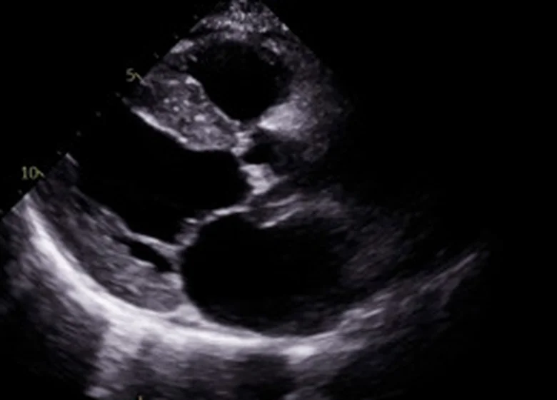 Ultraschall-Längsschnitt des Herzens in Graustufen: sehr dicke Kammerscheidewand und Hinterwand mit hellem, körnig glitzerndem Muster, kleine linke Kammer, großer dunkler linker Vorhof