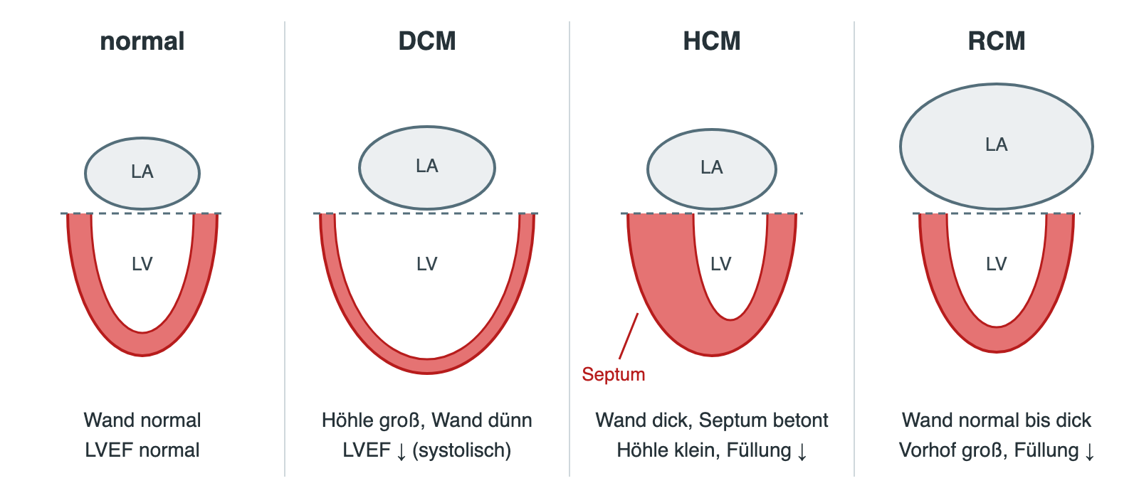 Schematischer Längsschnitt von linkem Vorhof und linkem Ventrikel bei normalem Herzen, DCM, HCM und RCM mit unterschiedlicher Wanddicke, Höhlengröße und Vorhofgröße