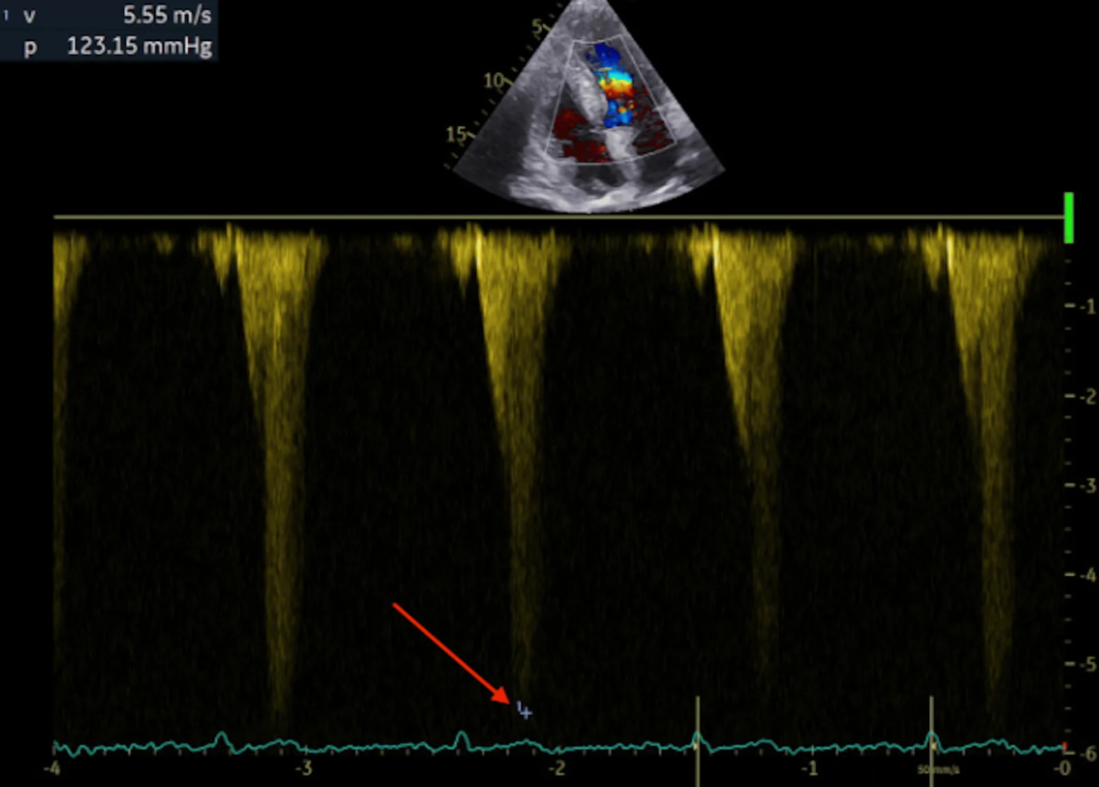 Echtes Continuous-Wave-Doppler-Spektrum durch den linksventrikulären Ausflusstrakt: oben ein kleines Farbdoppler-Bild, darunter vier gelbe, nach unten spitz zulaufende, spät gipfelnde Flusssignale bis etwa 5,5 Meter pro Sekunde; oben links die Messwerte, ein roter Pfeil auf die Spitze eines Signals