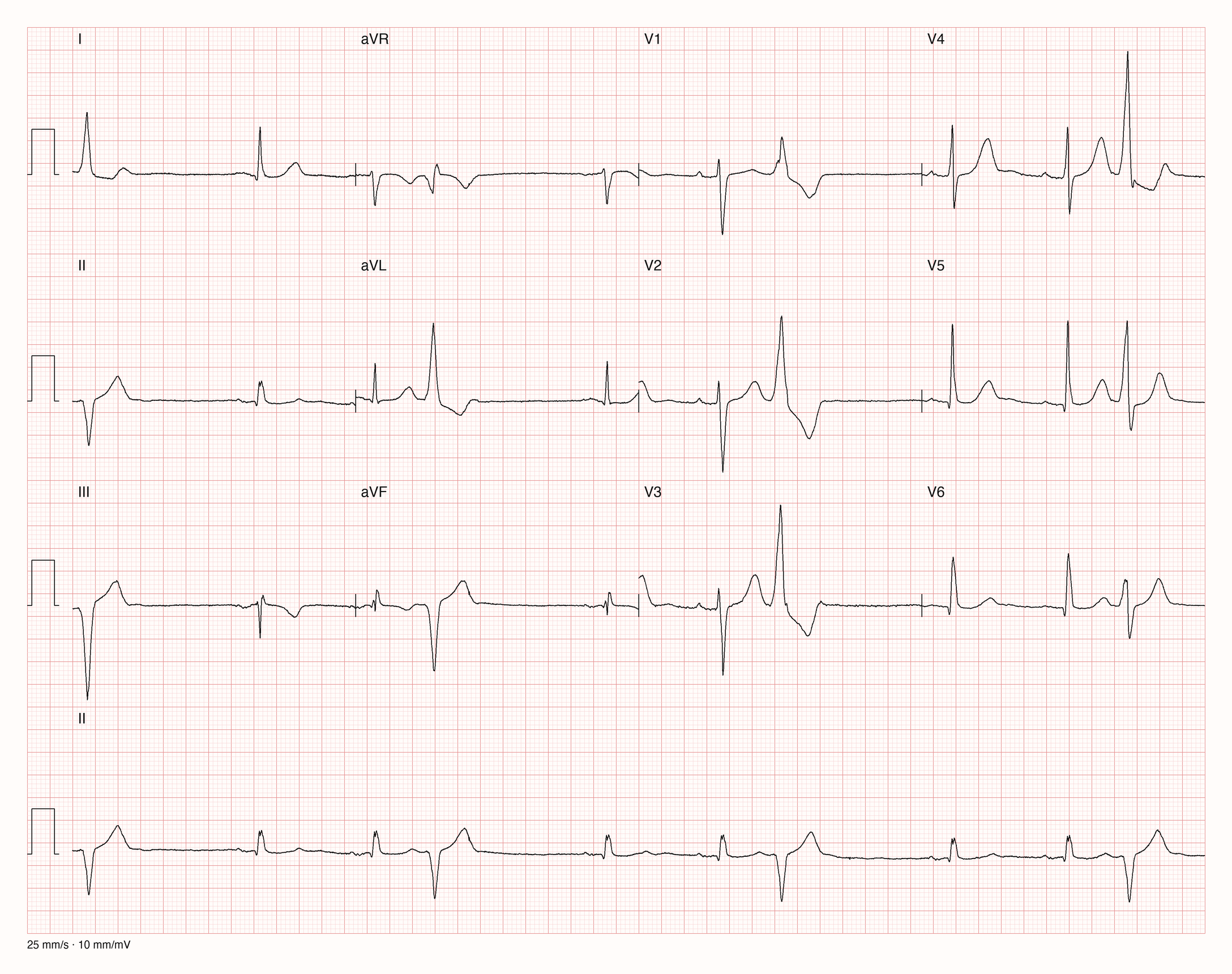 Echtes 12-Kanal-EKG eines 67-jährigen Mannes mit DCM: Sinusrhythmus mit schmalen QRS-Komplexen, jede dritte Aktion ist eine breite, deformierte ventrikuläre Extrasystole