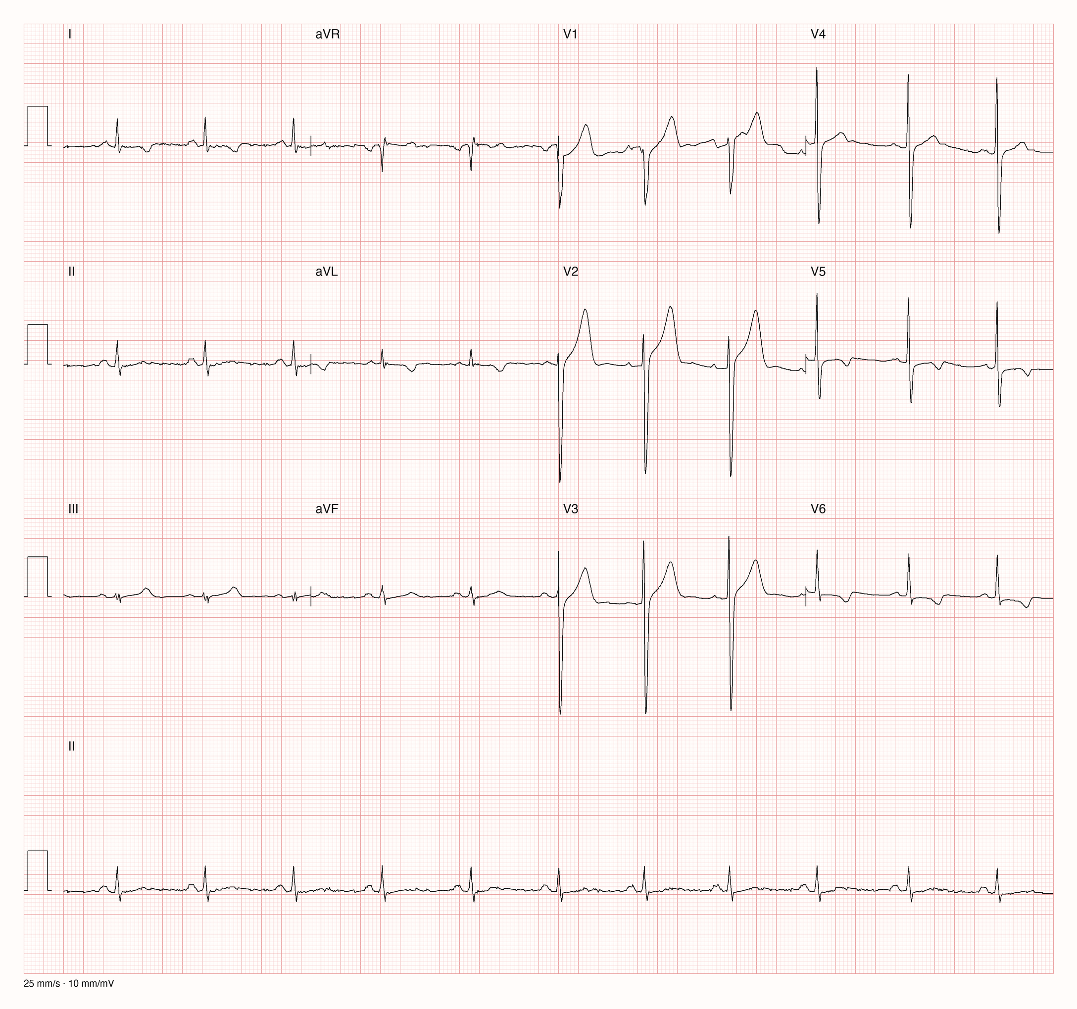 Echtes 12-Kanal-EKG eines 40-jährigen Mannes: Sinusrhythmus um 67/min, sehr hohe Amplituden in den Brustwandableitungen und flache bis leicht negative T-Wellen in I, aVL, V5 und V6
