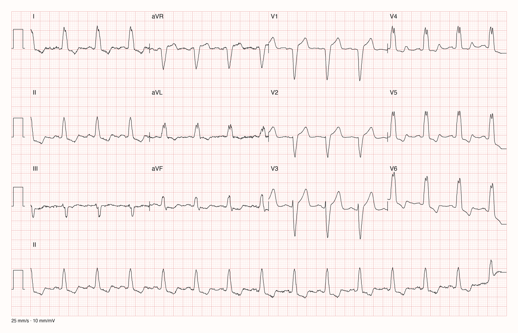 Echtes 12-Kanal-EKG: regelmäßiger Rhythmus um 87/min mit breiten QRS-Komplexen, tiefen QS-Komplexen in V1 bis V3 und breiten, gekerbten R-Zacken in I, aVL und V5 bis V6