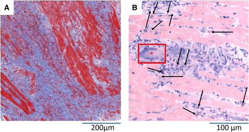 Zwei echte histologische Bilder einer Endomyokardbiopsie: links rot gefärbte Herzmuskelfasern zwischen ausgedehnten blauen Bindegewebsfeldern, rechts blassrosa Muskelfasern mit dichten Entzündungszellen, einer eingerahmten mehrkernigen Riesenzelle und Pfeilen auf einzelne Zellen