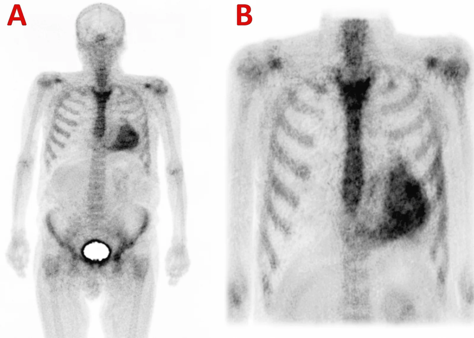 Echte Knochenszintigrafie, links Ganzkörperaufnahme von vorn, rechts vergrößerter Thorax: das Herz links im Thorax speichert den Tracer dunkler als die Rippen, die Rippen sind nur schwach sichtbar; im Becken ein heller, gesättigter Fleck der Harnblase