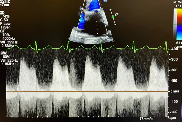 Continuous-Wave-Doppler-Spektrum durch die Mitralklappe mit fünf diastolischen Flussprofilen oberhalb der Nulllinie bis knapp 3 m/s, darüber das kleine Schnittbild und die EKG-Spur; Herzfrequenz 95/min