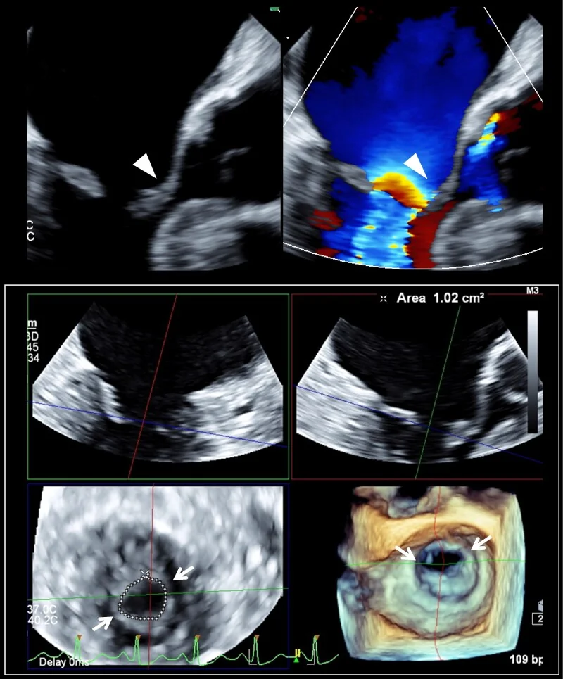 Oben zwei TEE-Bilder der Mitralklappe, links in Graustufen mit kuppelförmig vorgewölbtem vorderem Segel, rechts mit Farbdoppler und Flussbeschleunigung an der Klappe; unten dreidimensionale Rekonstruktion mit kleiner, umrandeter Öffnungsfläche von 1,02 cm² und zwei Pfeilen auf die Kommissuren
