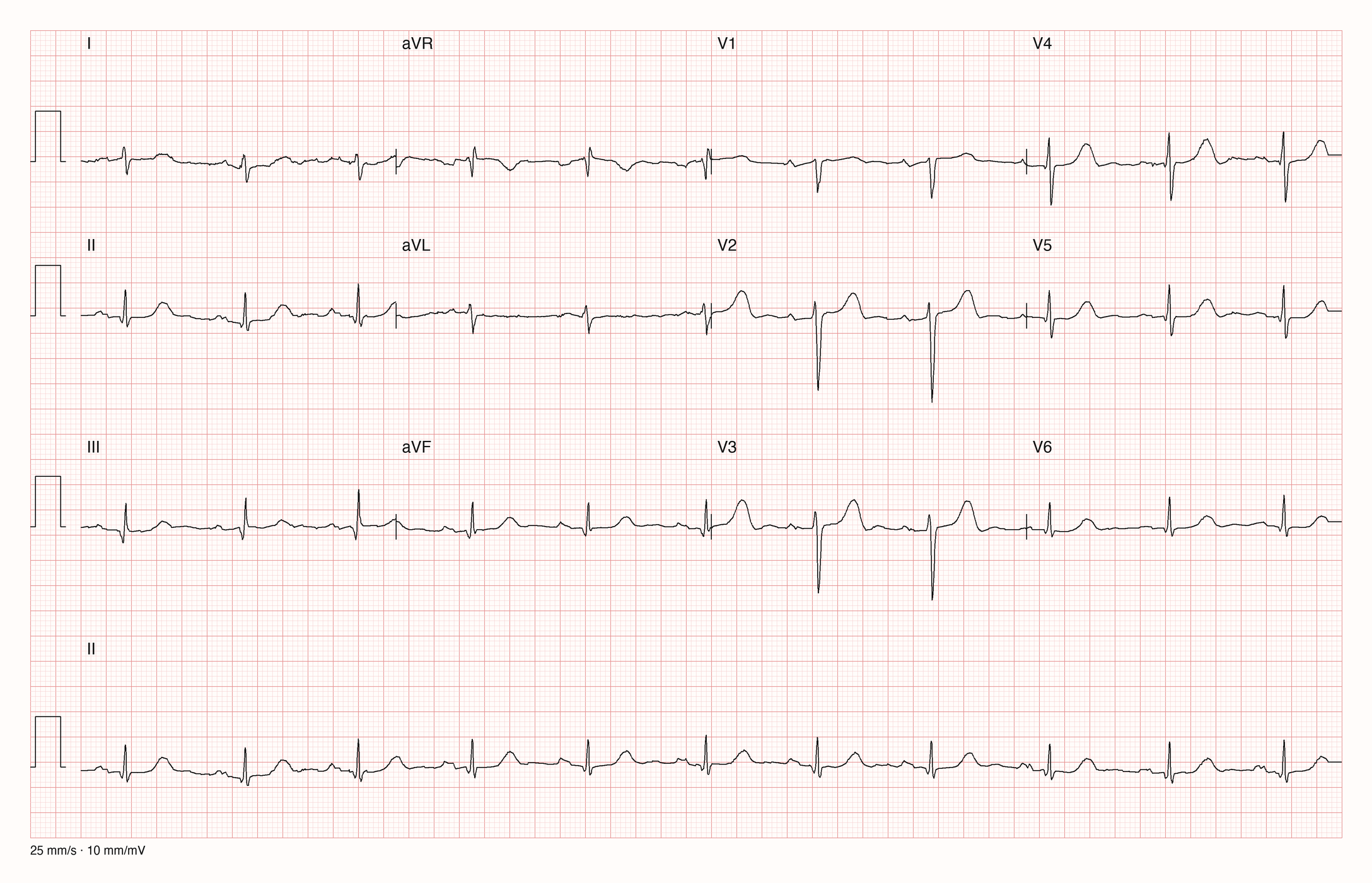 12-Kanal-EKG im Sinusrhythmus mit kleinen Ausschlägen in den Extremitätenableitungen; P-Welle in V1 mit breitem negativem Endteil; Kalibrierzacke 10 mm/mV, 25 mm/s