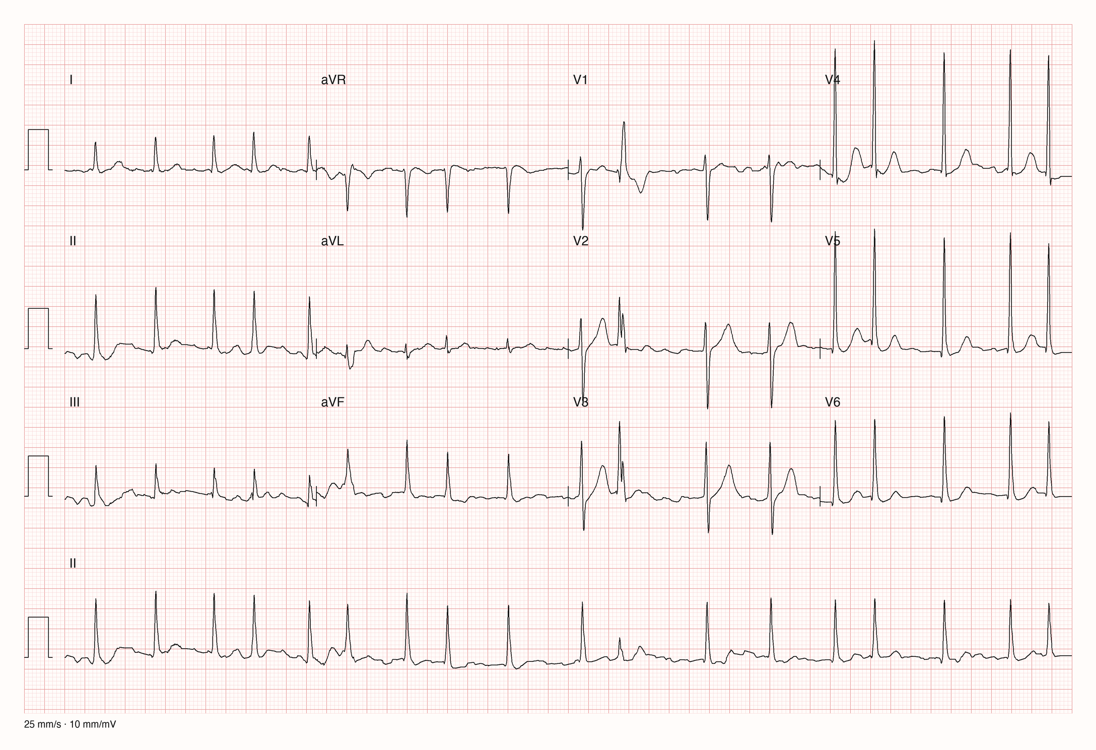 12-Kanal-EKG mit unregelmäßigen RR-Abständen ohne erkennbare P-Wellen und hohen QRS-Ausschlägen in den linken Brustwandableitungen; 25 mm/s, 10 mm/mV