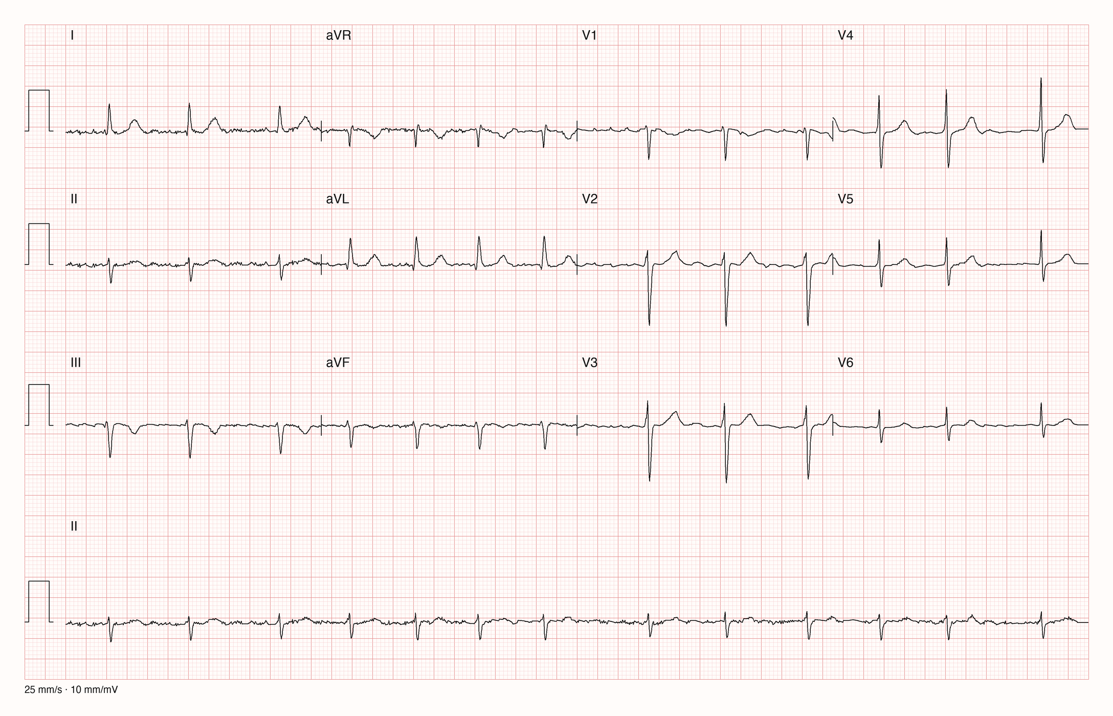 12-Kanal-EKG mit unregelmäßigen RR-Abständen, ohne P-Wellen, normaler Kammerfrequenz und überwiegend negativem QRS in II, III und aVF; 25 mm/s, 10 mm/mV