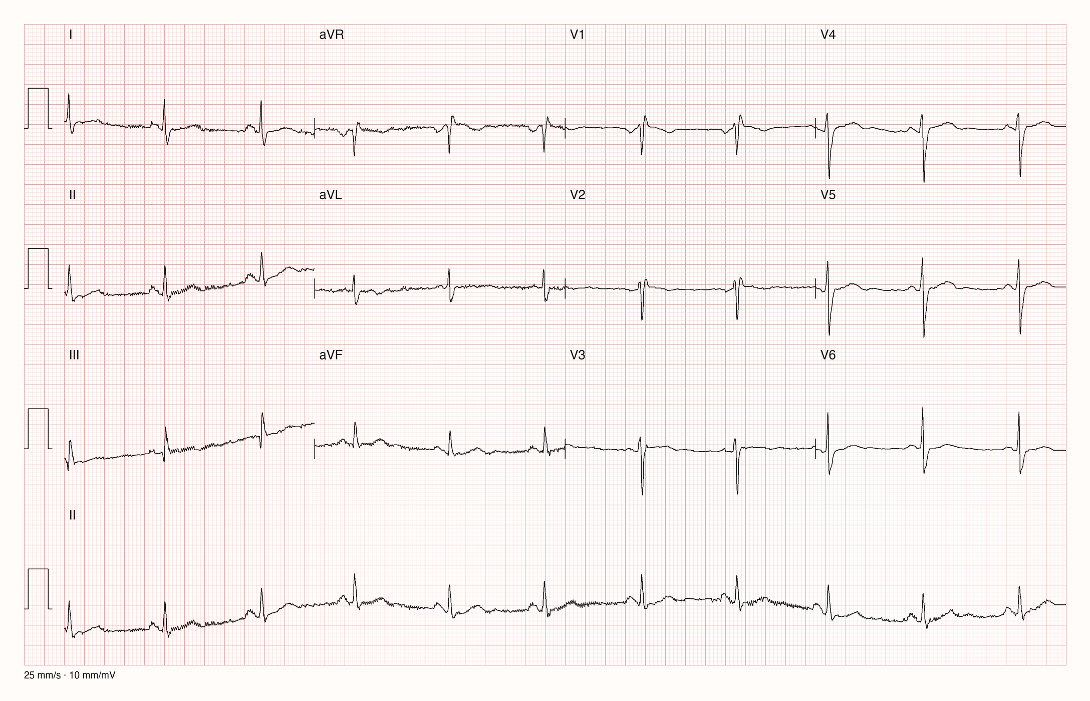 12-Kanal-EKG im Sinusrhythmus mit unruhiger Grundlinie in den Extremitätenableitungen, rSr'-Form in V1 und tiefen S-Zacken bis V5 und V6; 25 mm/s, 10 mm/mV
