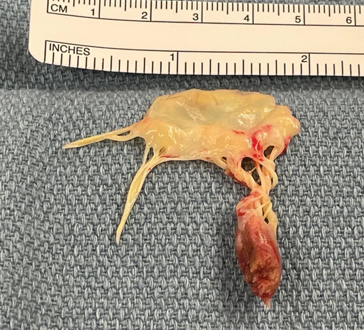 Operationspräparat auf blauem Tuch unter einem Lineal: oben ein gelblicher Segelanteil mit Sehnenfäden, unten an den Sehnenfäden ein dunkelroter, etwa 2 cm langer Muskelkopf