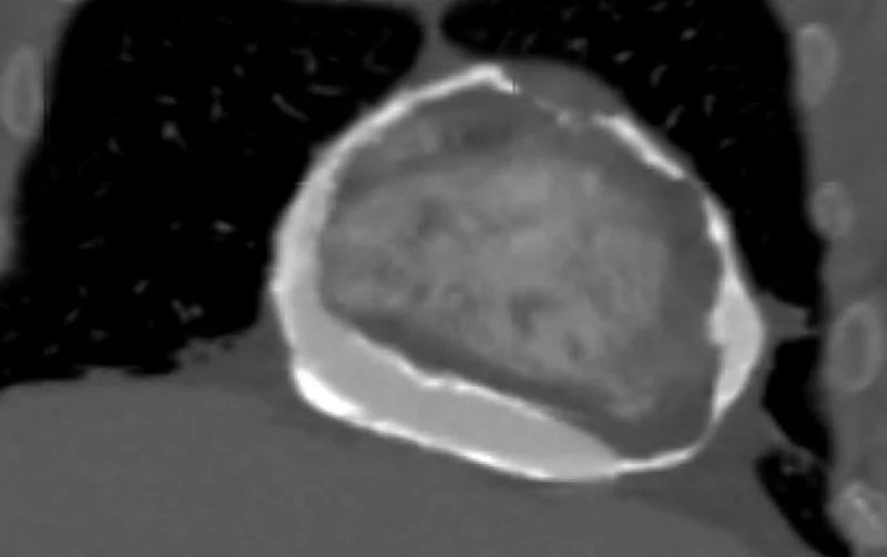 Echtes CT-Bild in koronarer Schnittführung: Das Herz ist von einer dicken, hellweißen, schalenartigen Kalkhülle umgeben, die an der Unterseite über dem Zwerchfell besonders breit ist.
