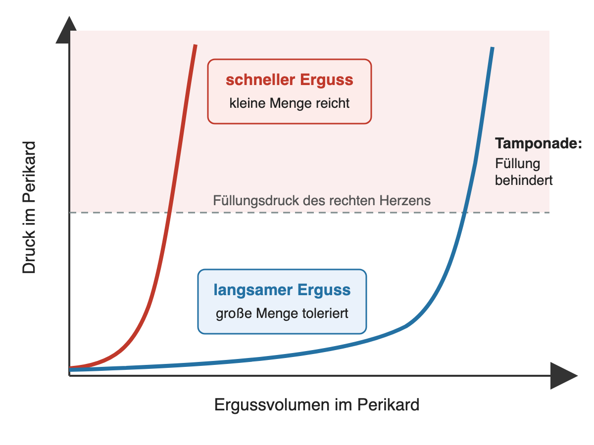 Diagramm: Druck im Perikard gegen Ergussvolumen; die Kurve für schnellen Erguss steigt nach kleiner Menge steil an, die Kurve für langsamen Erguss bleibt lange flach und steigt erst spät; oberhalb des Füllungsdrucks des rechten Herzens ist die Füllung behindert