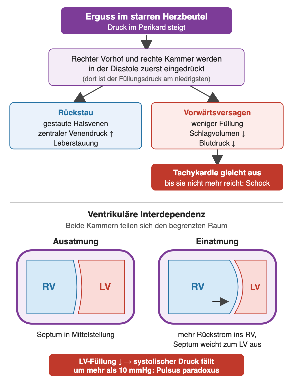 Flussdiagramm zum Tamponade-Mechanismus mit Rückstau und Vorwärtsversagen sowie zwei schematische Kammerbilder für Aus- und Einatmung, in denen das Septum bei Einatmung zur linken Kammer ausweicht
