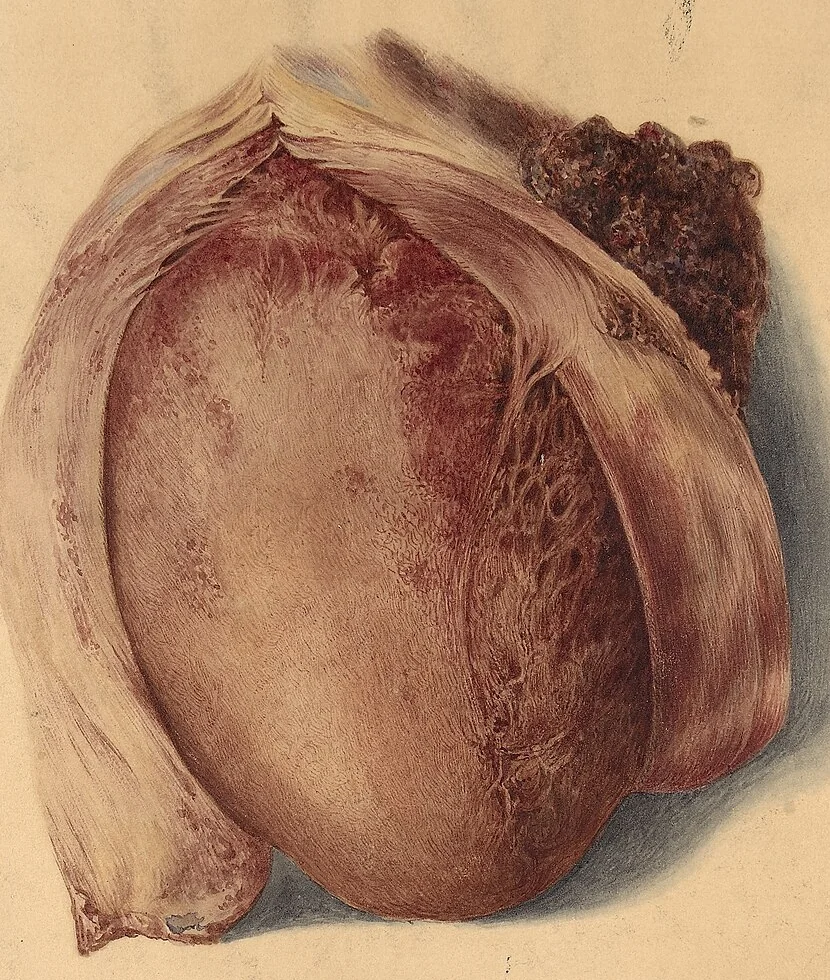 Historisches Aquarell eines Sektionsherzens: Der Herzbeutel ist aufgeklappt und zur Seite geschlagen; die Herzoberfläche ist mit einem rauen, netzartigen, rötlich-braunen Belag bedeckt.