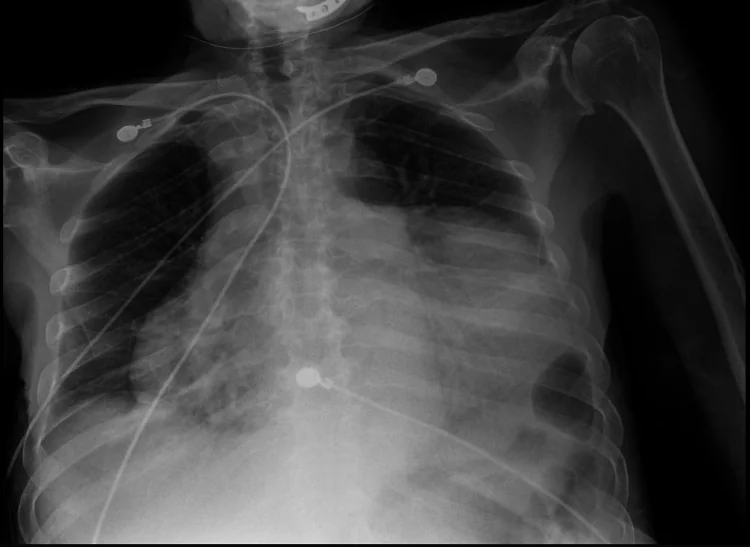 Echte Röntgen-Thorax-Bettaufnahme von vorne: Der Herzschatten ist nach beiden Seiten stark verbreitert, rund und plump; EKG-Elektroden und Kabel liegen auf dem Brustkorb.