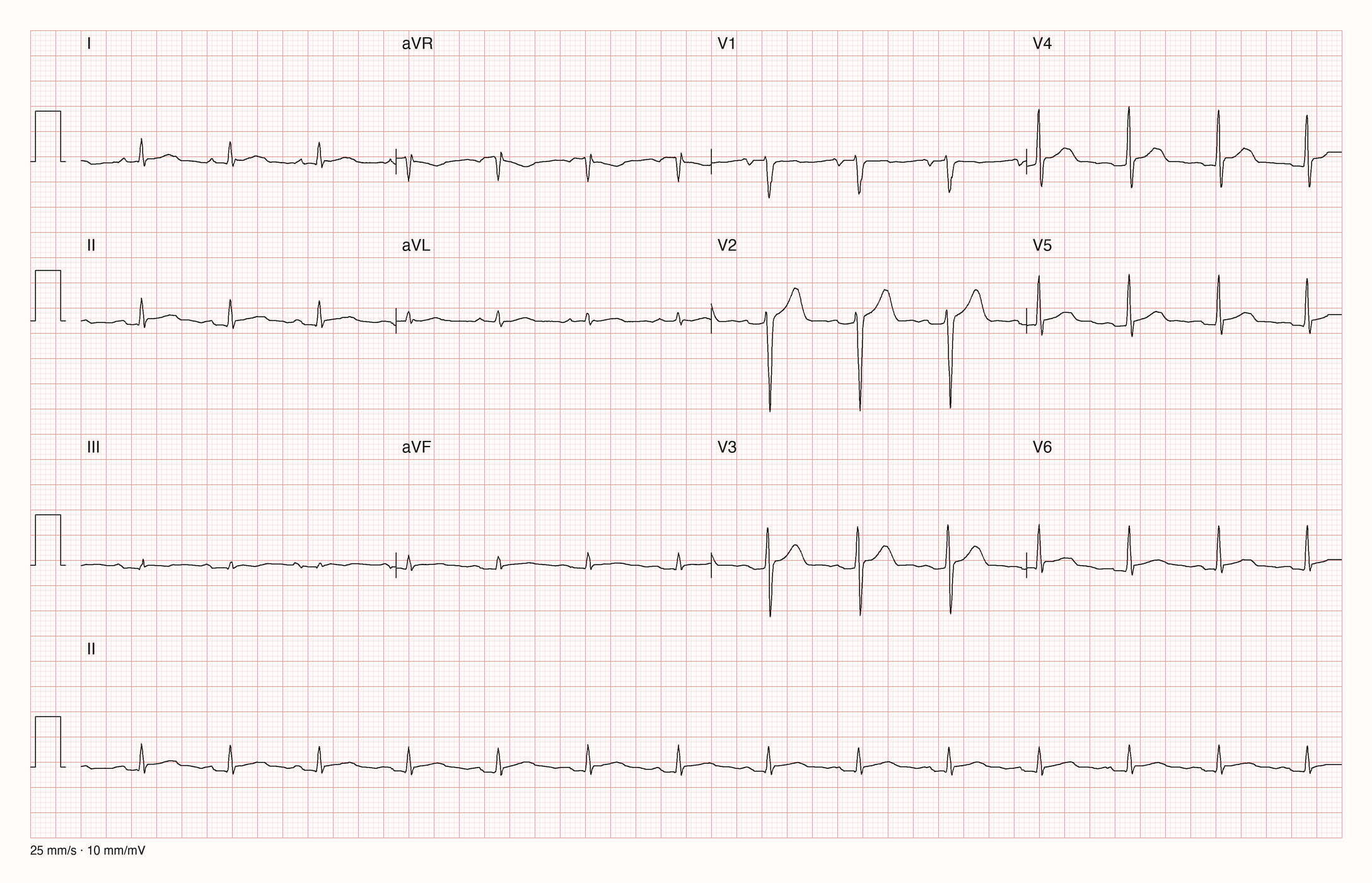 12-Kanal-EKG mit normofrequentem Sinusrhythmus, kleinen Ausschlägen in den Extremitätenableitungen und normal großen Ausschlägen in den Brustwandableitungen