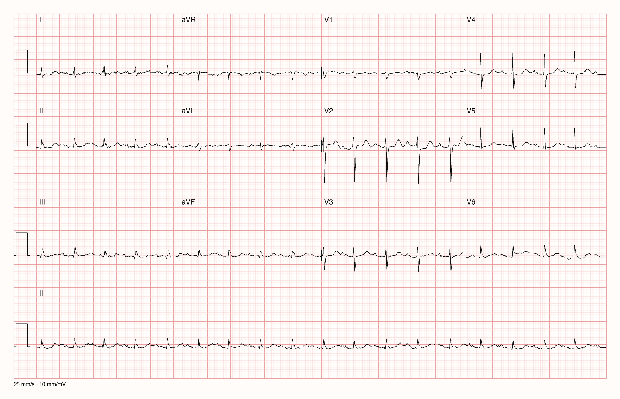 12-Kanal-EKG mit regelmäßigem schnellem Sinusrhythmus und sehr kleinen QRS-Ausschlägen in allen Extremitätenableitungen; leichte Muskelartefakte in I und II