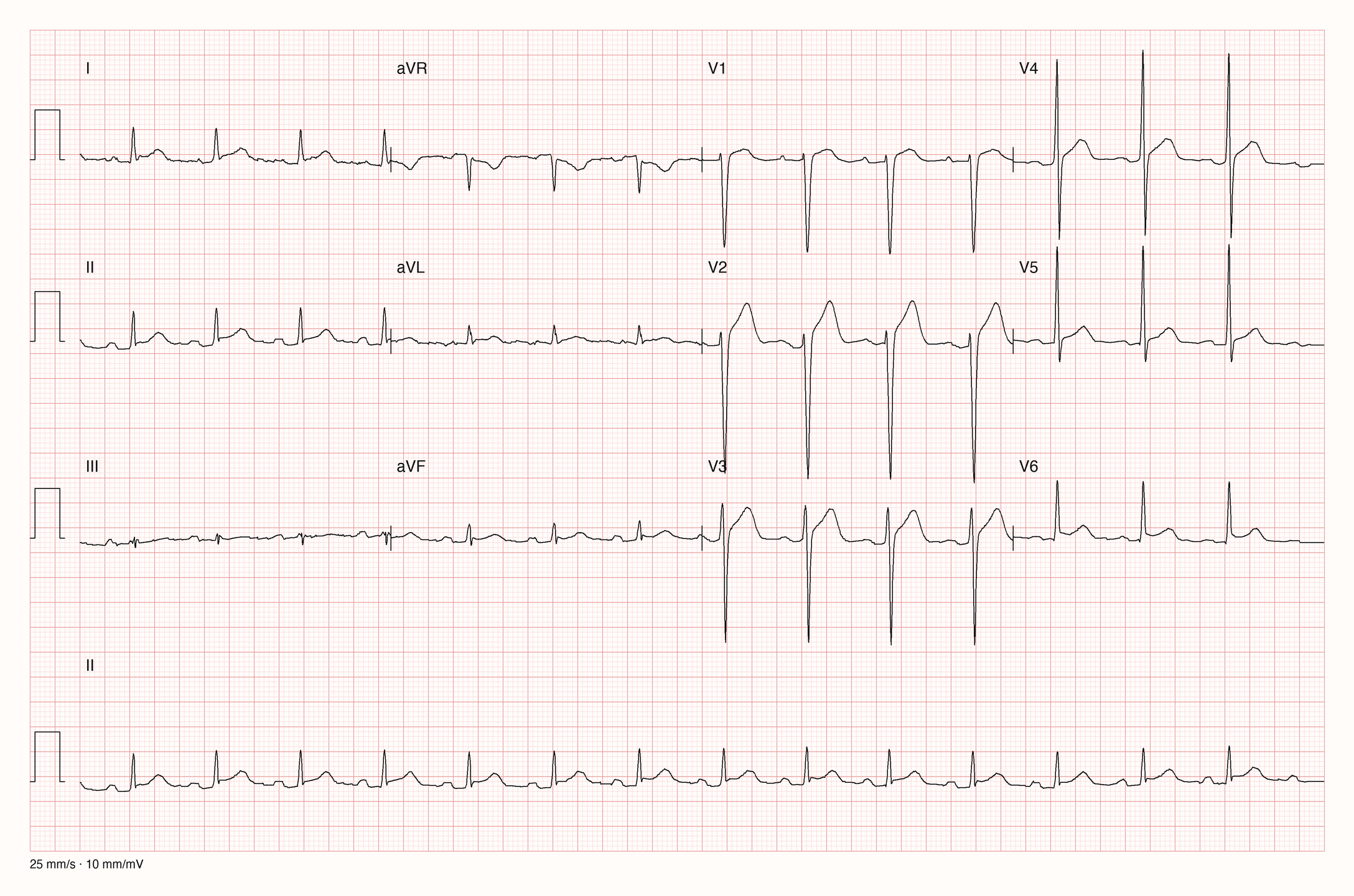 12-Kanal-EKG mit Sinusrhythmus, hohen Brustwandamplituden und konkaven ST-Hebungen vor allem in V1 bis V4; die Extremitätenableitungen haben kleine Ausschläge