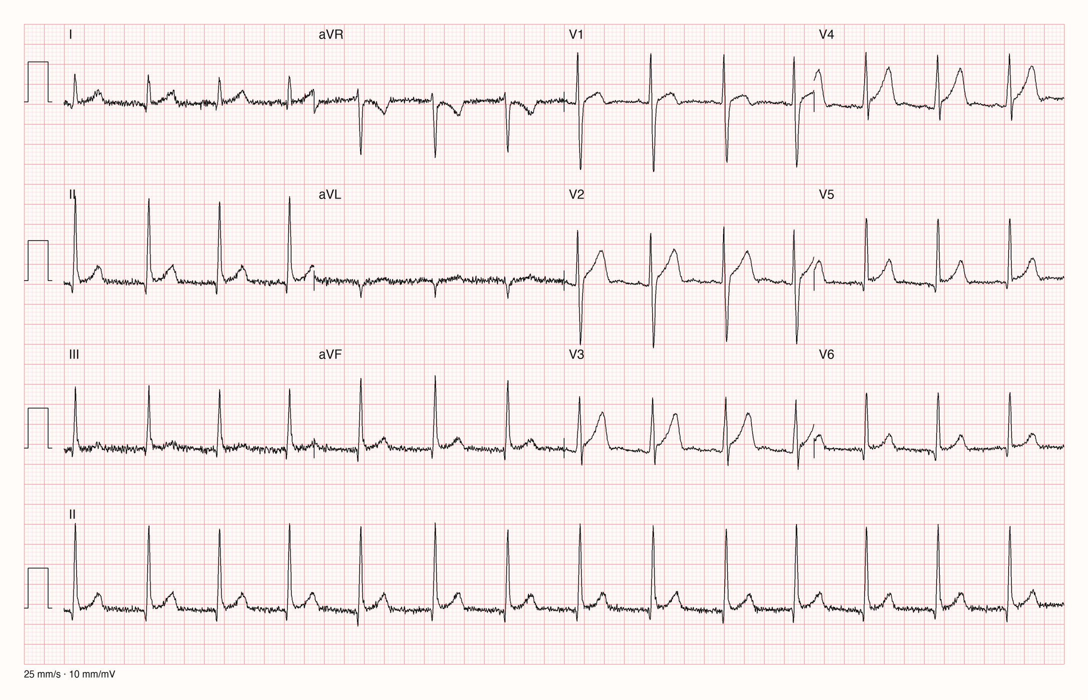 12-Kanal-EKG mit Sinusrhythmus, Steiltyp und konkaven ST-Hebungen in V2 bis V4 ohne ST-Senkungen in anderen Ableitungen; leichte Muskelartefakte