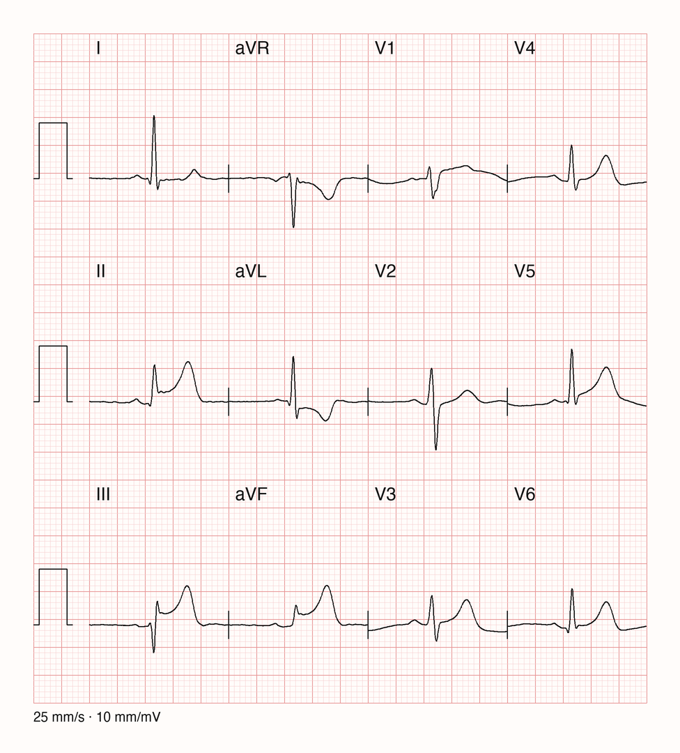 Medianschlag eines 12-Kanal-EKG mit ST-Hebung in II, III und aVF sowie ST-Senkung mit negativem T in aVL
