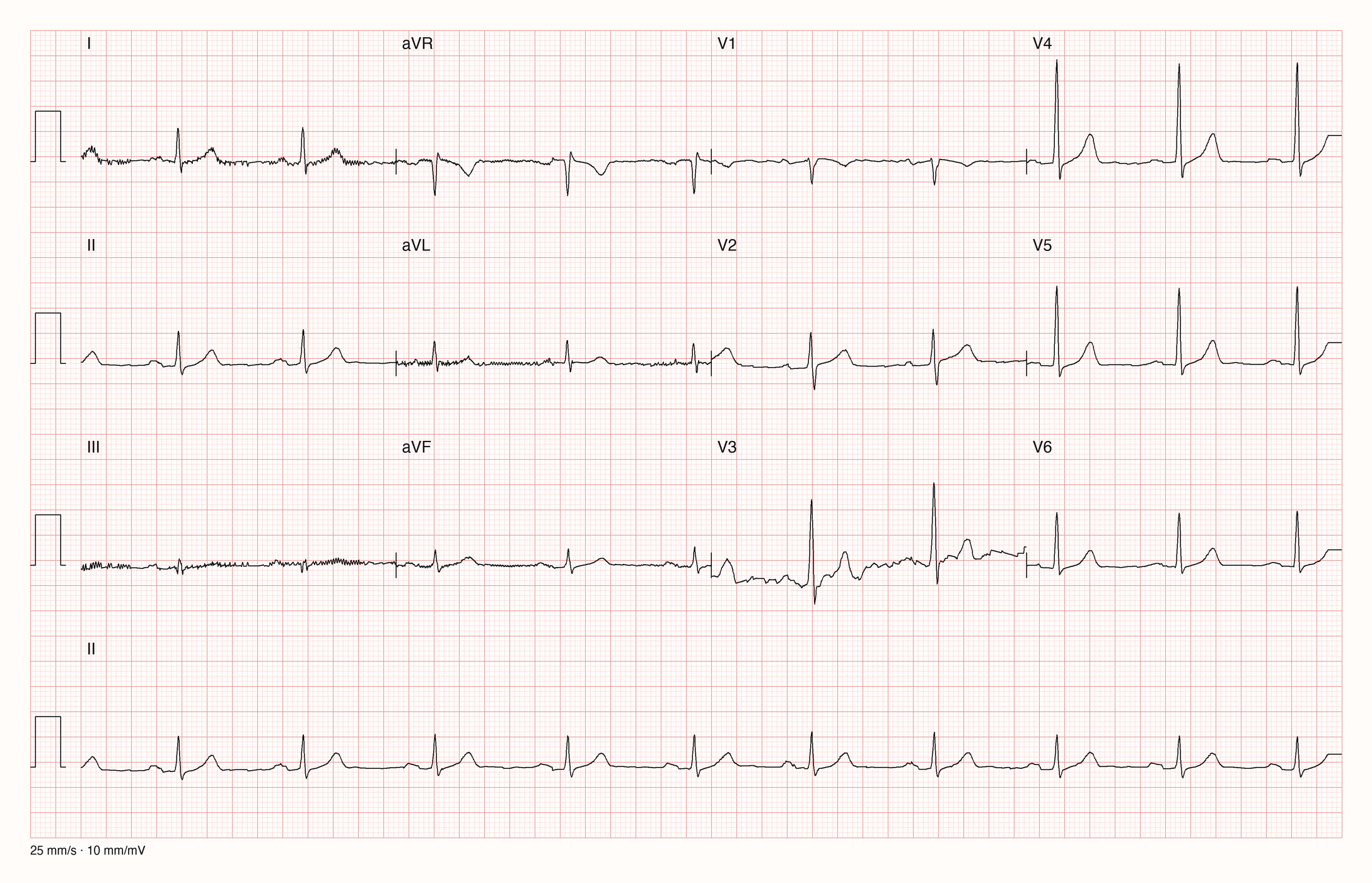 12-Kanal-EKG im Sinusrhythmus mit schmalen QRS-Komplexen und gut sichtbaren P-Wellen im Rhythmusstreifen; leichtes Muskelzittern in I, III und aVL