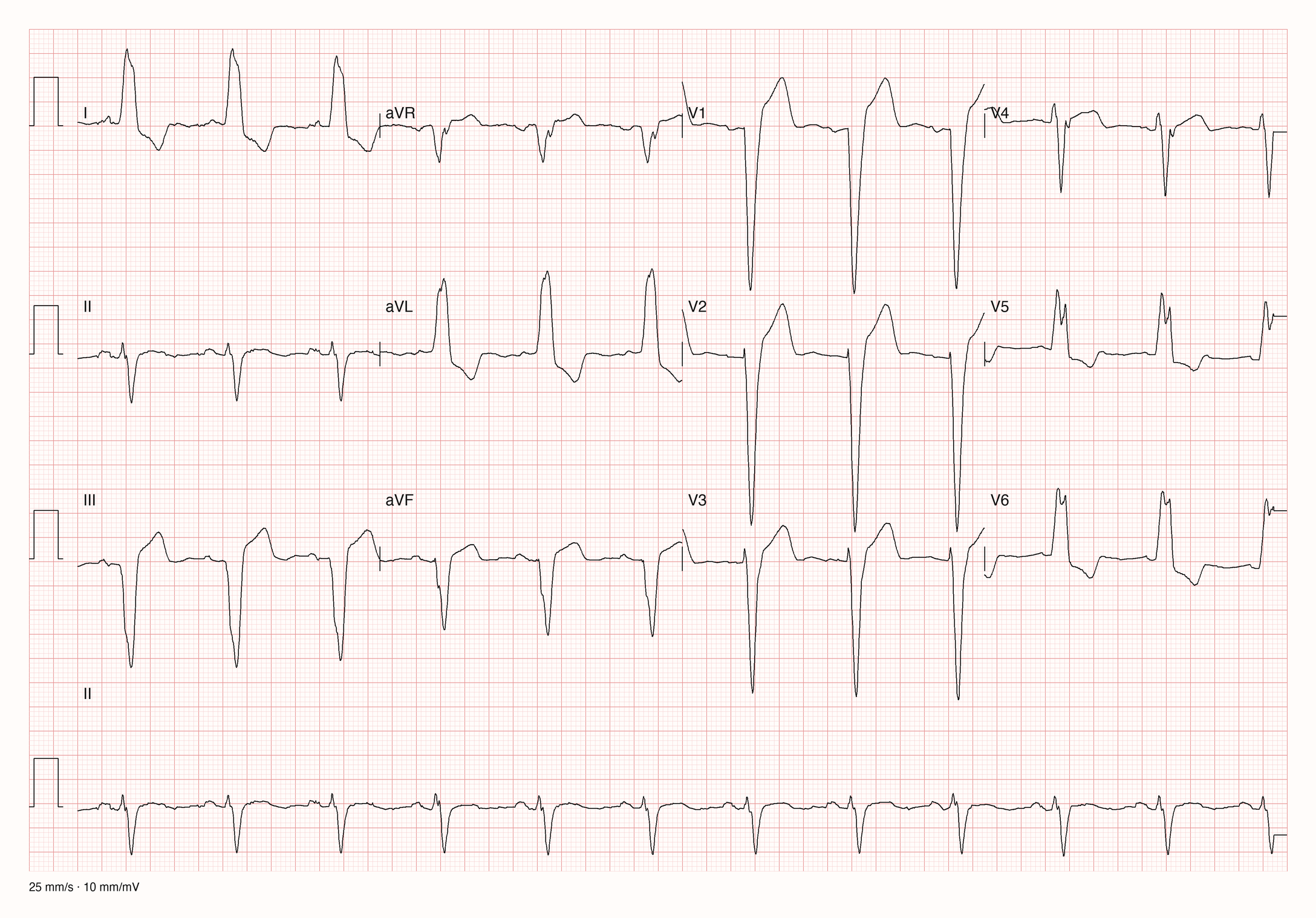 12-Kanal-EKG im Sinusrhythmus mit breiten QRS-Komplexen, tief negativem QRS in V1 bis V3, breiten gekerbten R-Zacken in I, aVL, V5 und V6 und gegenläufigen ST-T-Veränderungen