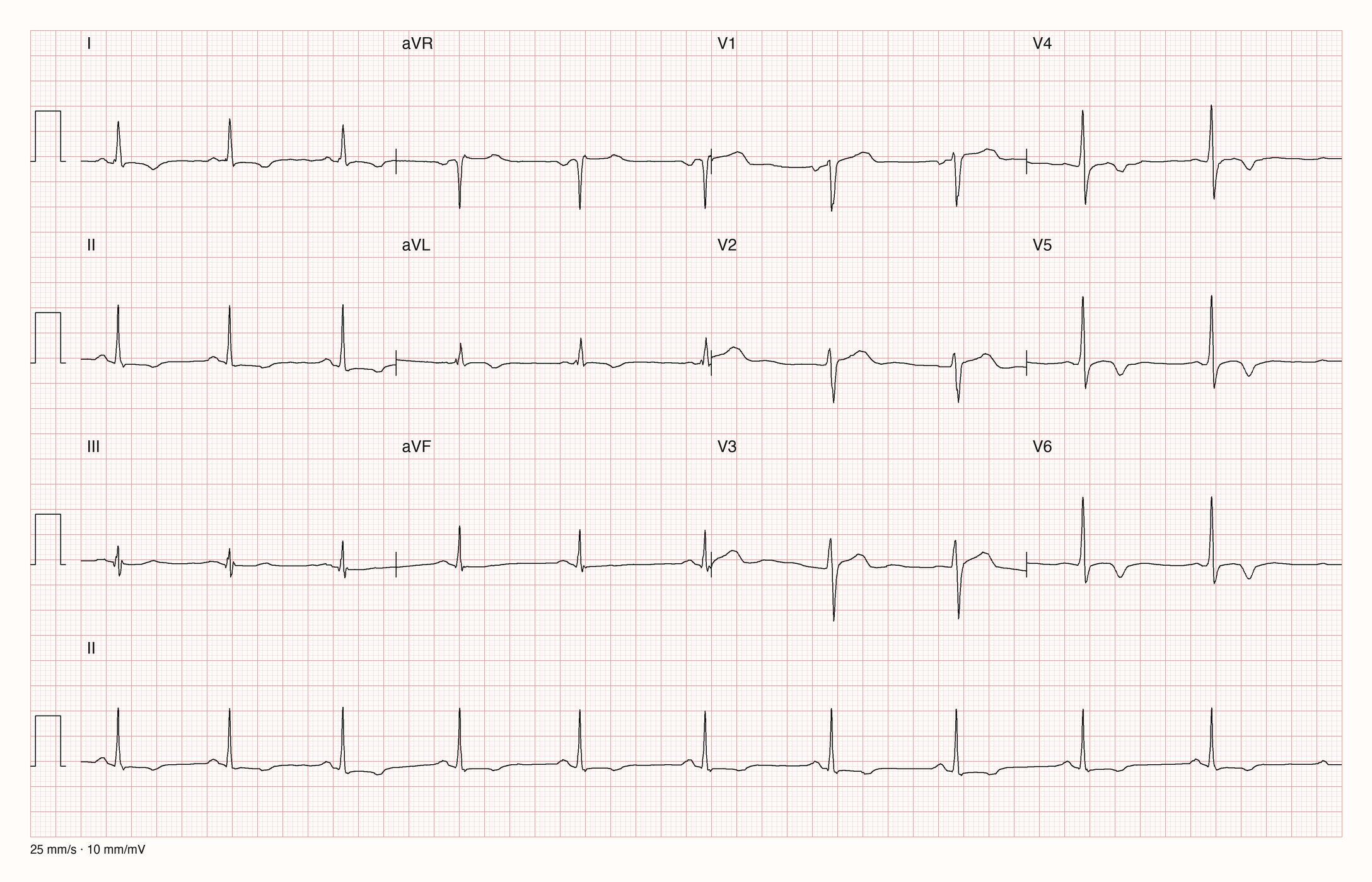 12-Kanal-EKG im Sinusrhythmus mit schmalen QRS-Komplexen und negativen T-Wellen in V4 bis V6 sowie flachen bis leicht negativen T-Wellen in I, II und aVL