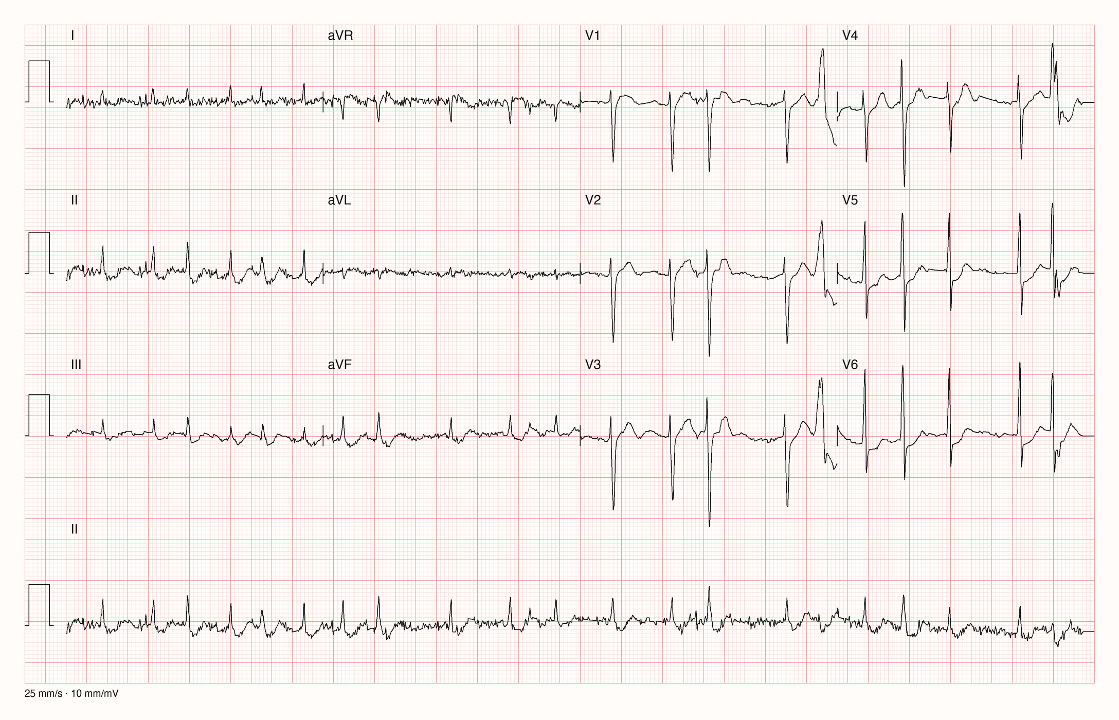 12-Kanal-EKG mit schneller unregelmäßiger Kammeraktion ohne erkennbare P-Wellen, unruhiger Grundlinie in den Extremitätenableitungen, kleinen Ausschlägen in I und aVL und einem breiten vorzeitigen Komplex in den Brustwandableitungen
