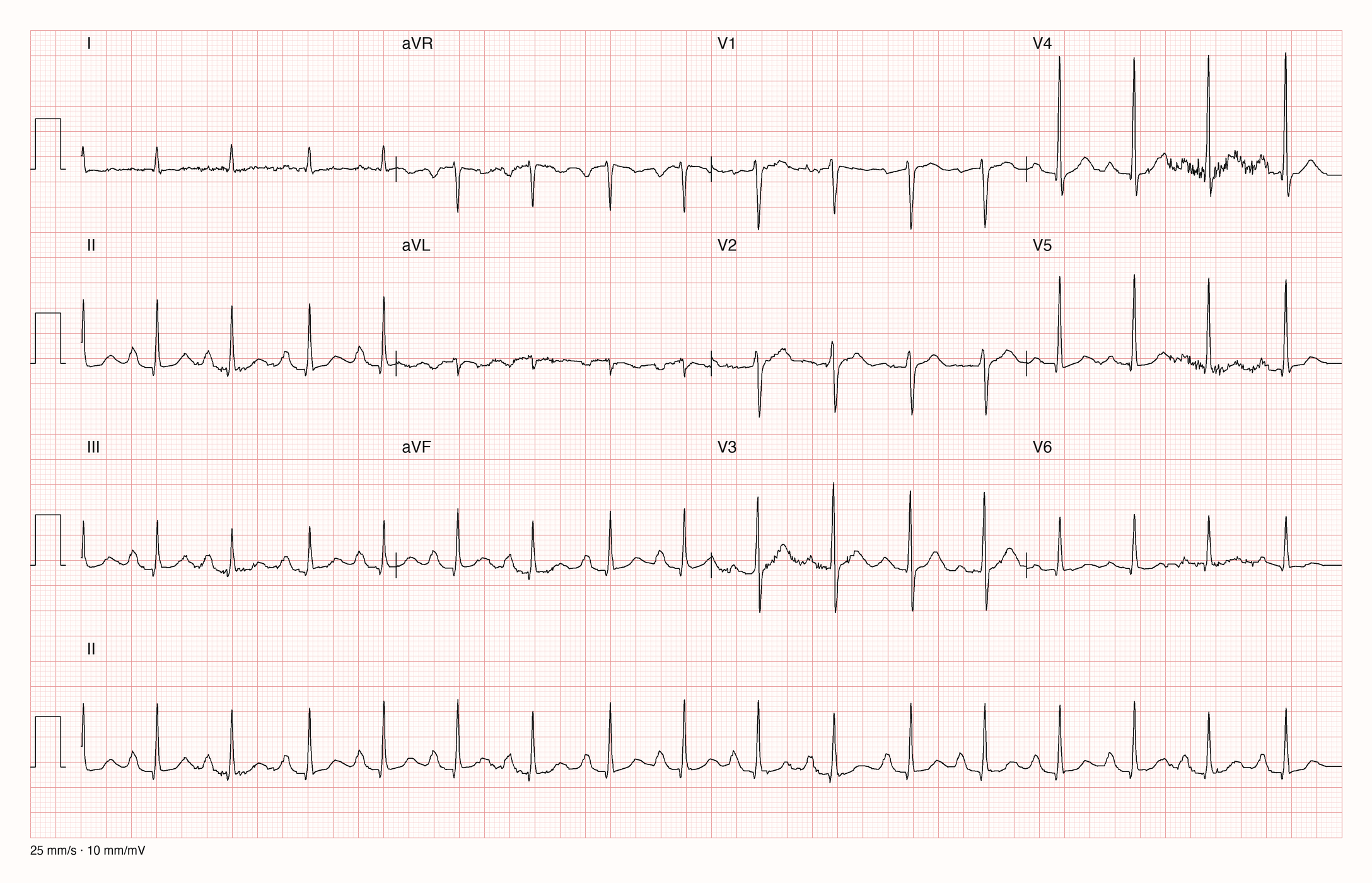 12-Kanal-EKG mit regelmäßiger Tachykardie um 100 pro Minute, hohen spitzen P-Wellen in II, III und aVF und schmalen QRS-Komplexen; Muskelzittern in V4 und V5