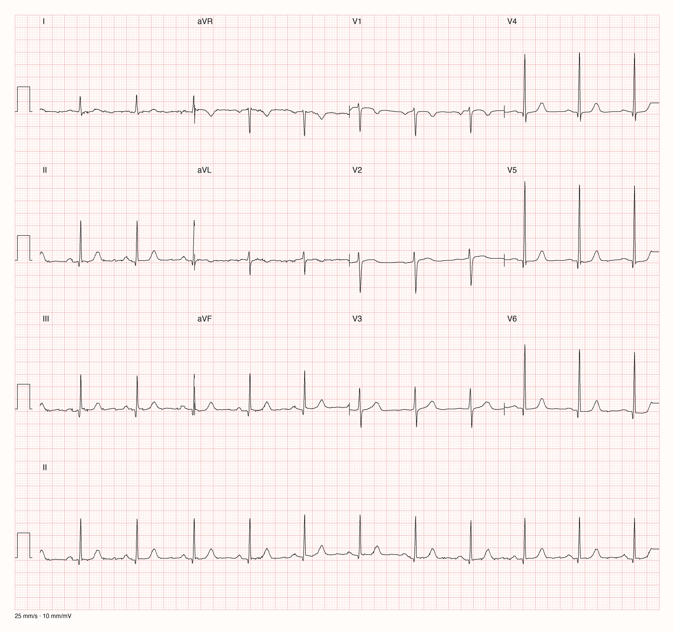 12-Kanal-EKG im Sinusrhythmus mit sehr hohen R-Zacken in V4 bis V6, tiefen S-Zacken in V1 und V2 und positiven T-Wellen; Zeilen mit erhöhtem Abstand
