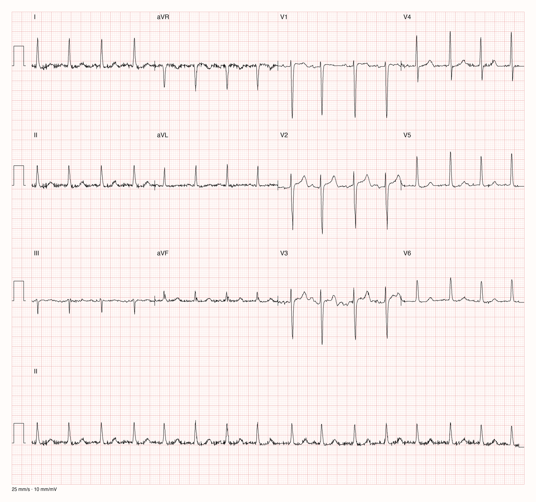 12-Kanal-EKG im Sinusrhythmus mit Muskelzittern in den Extremitätenableitungen, sehr tiefen S-Zacken in V1 bis V3 mit leicht angehobener ST-Strecke und hohen R-Zacken in V4 und V5