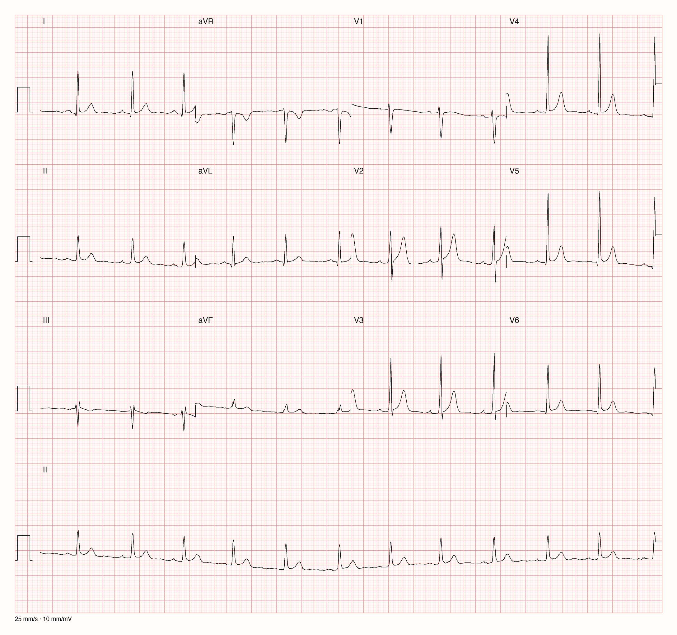 12-Kanal-EKG im Sinusrhythmus mit hohen R-Zacken in V3 bis V5, hohen T-Wellen in V2 bis V5 und ohne T-Negativierungen; Zeilen mit erhöhtem Abstand