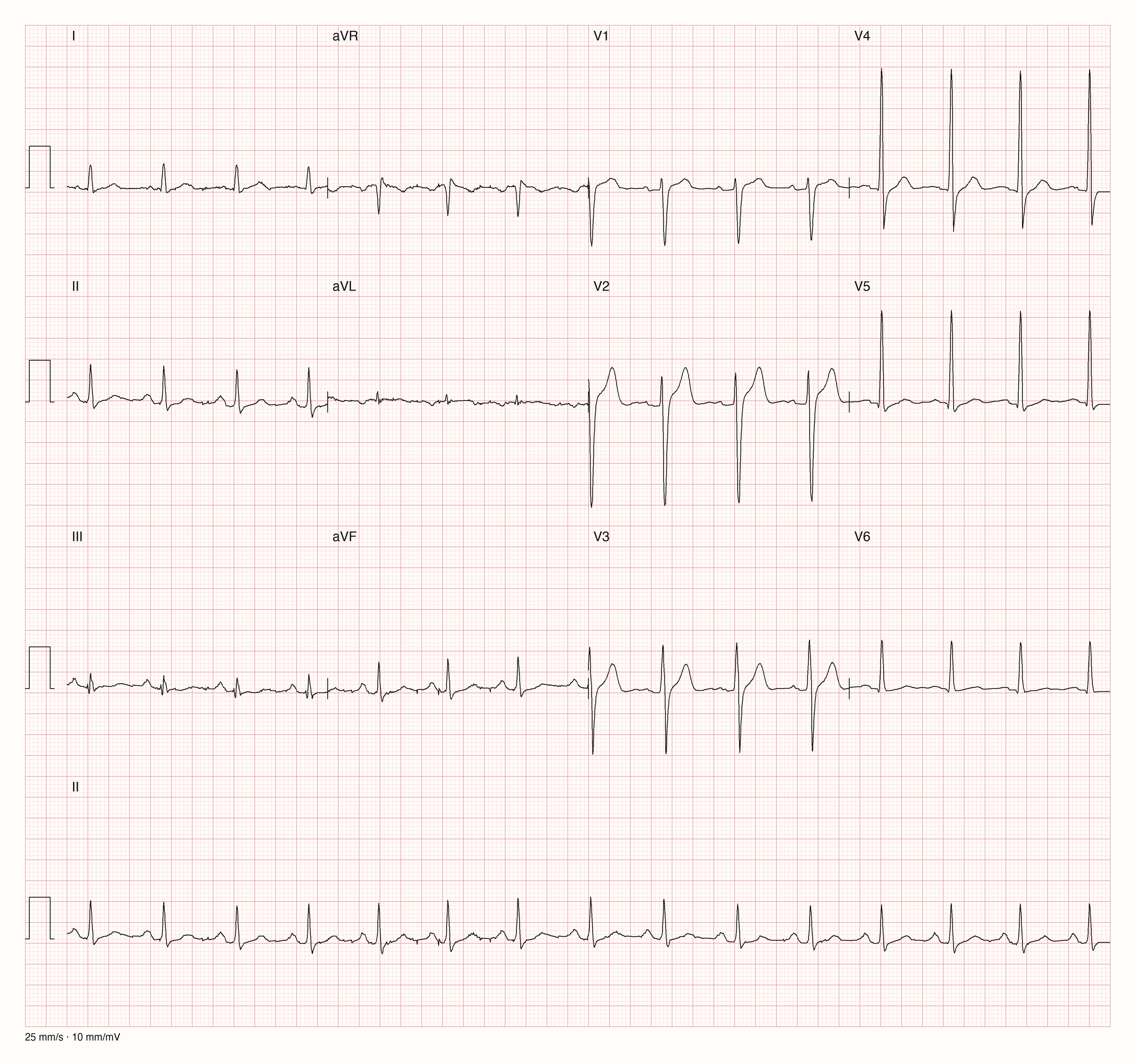 12-Kanal-EKG im Sinusrhythmus mit tiefen S-Zacken in V1 und V2, hoher R-Zacke in V4 und leicht angehobener ST-Strecke in V2 und V3; Zeilen mit erhöhtem Abstand